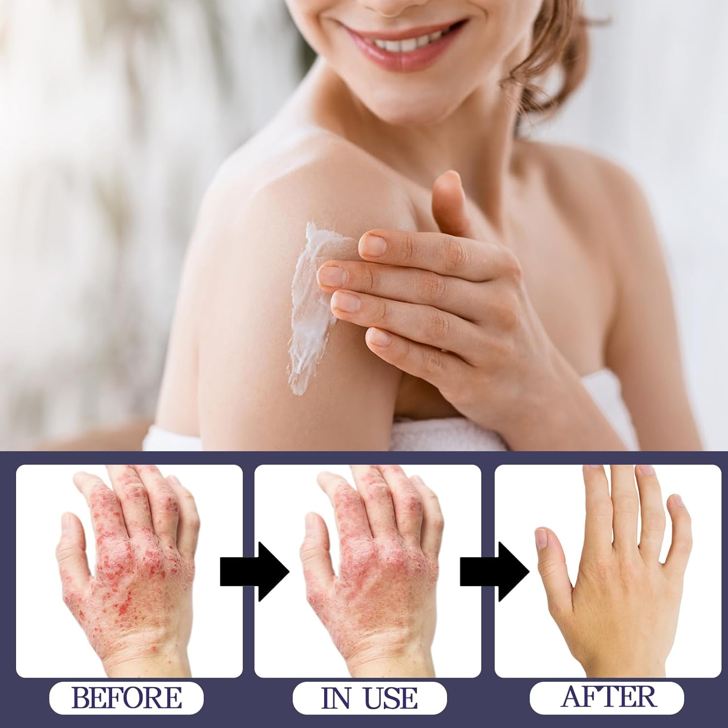 Psoriasis Creams Dermatitis Cream,Eczema,Soothes Red & Inflamed Skin,Moisturizing Body Cream,Lotion image number 5