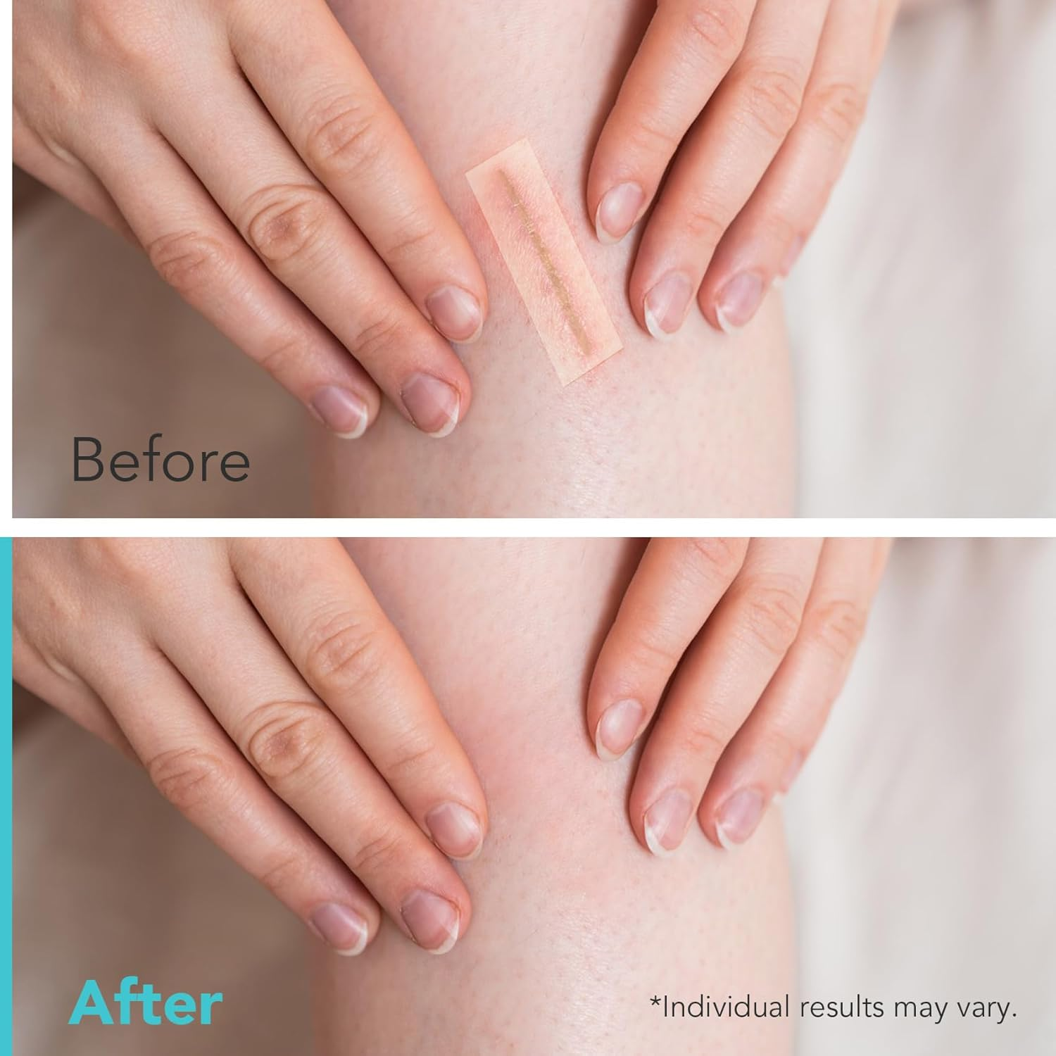 Hydrocolloid Roll for Wound Care - Cut-To-Size Hydrocolloid Patch,Extra Large Self-Adhesive Bandage,Ultra Absorbent & Waterproof Bandage,First Aid Essential (2In X 12Ft) image number 6