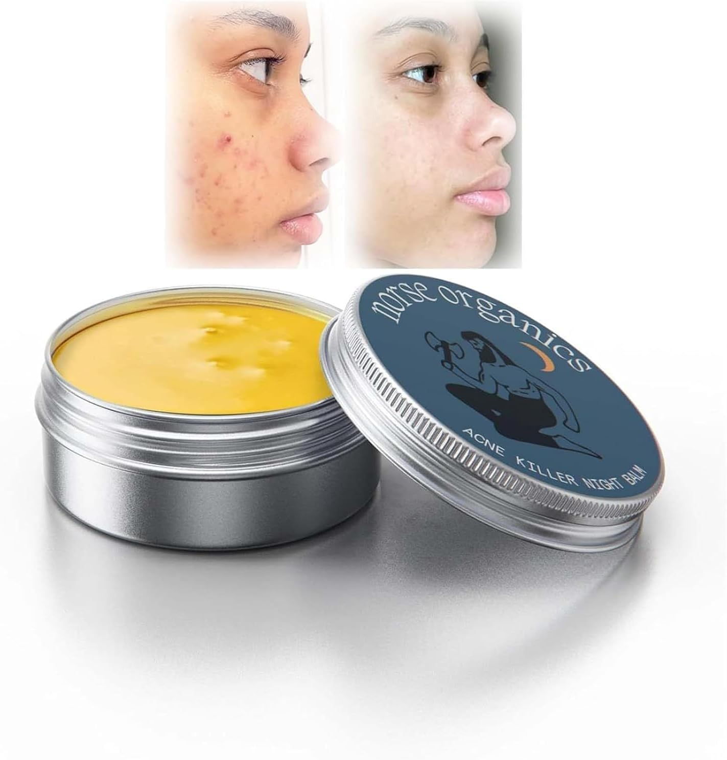 Norse Organics Acne & Redness Killer, Norse Organics Acne Balm, Acne Remove Skin Care Set, Ultra-Performance Skincare,1 Pcs image number 1