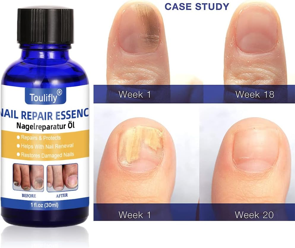 Nail Care and Treatment, Nail Repair, Nail Care for Healthy Foot and Hand, Nail Oil, Nail Care Oil, Nail Care Nourishing, Nail Essence Serum, for Broken and Discoloured Nails image number 2