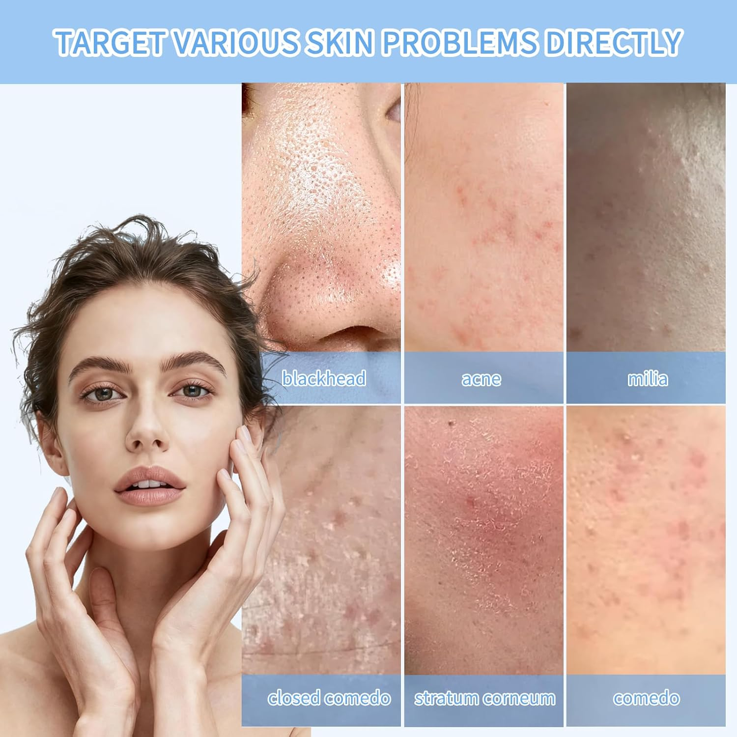 213-Piece Skincare Set: 100 Disposable Needles + 108 Acne Stickers + 5-In-1 Tool for Universal Skincare Tools, Compatible with Blackhead Remover and Skin Tag Remover Needs image number 1