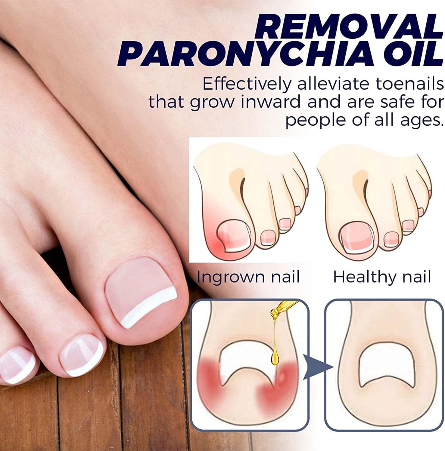 German Toenailcare Removal Paronychia Oil, German Toenailplus anti Paronychia Relief Oil, 2023 New German Toenail Care Removal Paronychia Oil (2PCS)