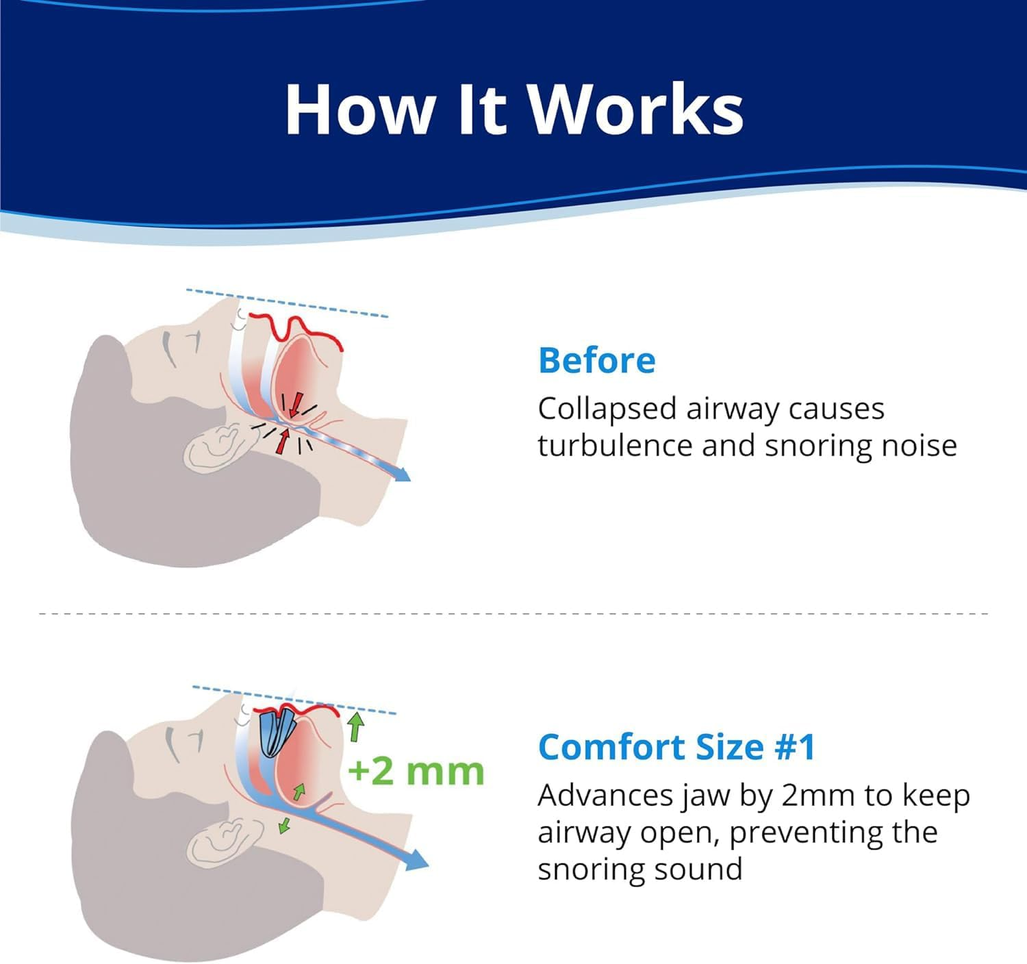 Anti-Snoring Mouthpiece, Comfort Size #1, Single Refill, Blue, Made in USA, Bpa-Free, Medical-Grade Material (Blue) image number 5