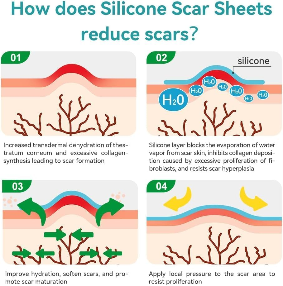 Dimora Medical Grade Silicone Scar Sheets - Ultra Soft Silicone Scar Tape (4Cmx3M), Waterproof Scar Treatment for Surgical Scars, C Section, Tummy Tuck, Keloid Treatment image number 6