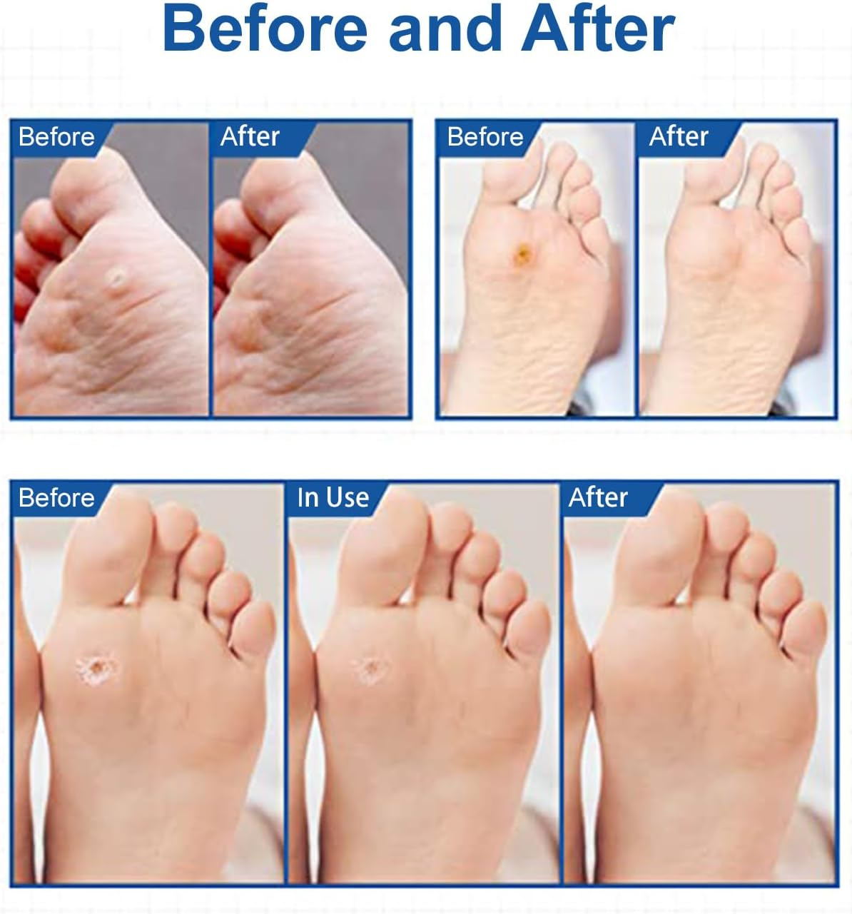 MYMULIKE 48Pcs Corn Removers for Toes & Feet, Tackle Tough Corns with Ease, 0.4" Diameter Large Size, Experience Quick Recover with Powerful, Easy-To-Use Corn Removal image number 5