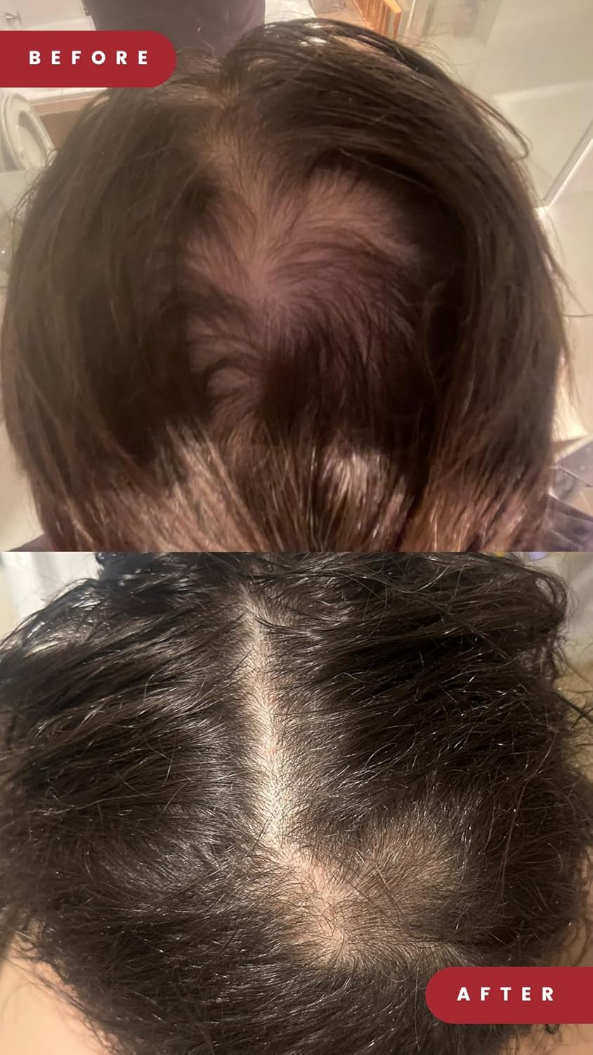 Grow Laser Cap 280 Medical Grade Laser Diodes for Hair Regrowth Men and Women, FDA Cleared, At-Home Hair Loss Regrowth Device, Low Level Laser Therapy (LLT) image number 5