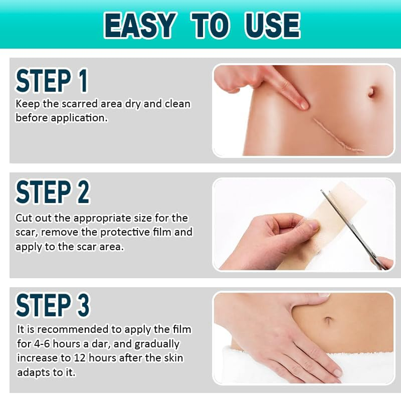 Medical-Grade Silicone Scar Tape &ndash; 4Cm X 2.1M Roll &ndash; Skin-Coloured, Breathable, Reusable Strip with Protective Backing &ndash; Soft, Skin-Like Texture image number 4