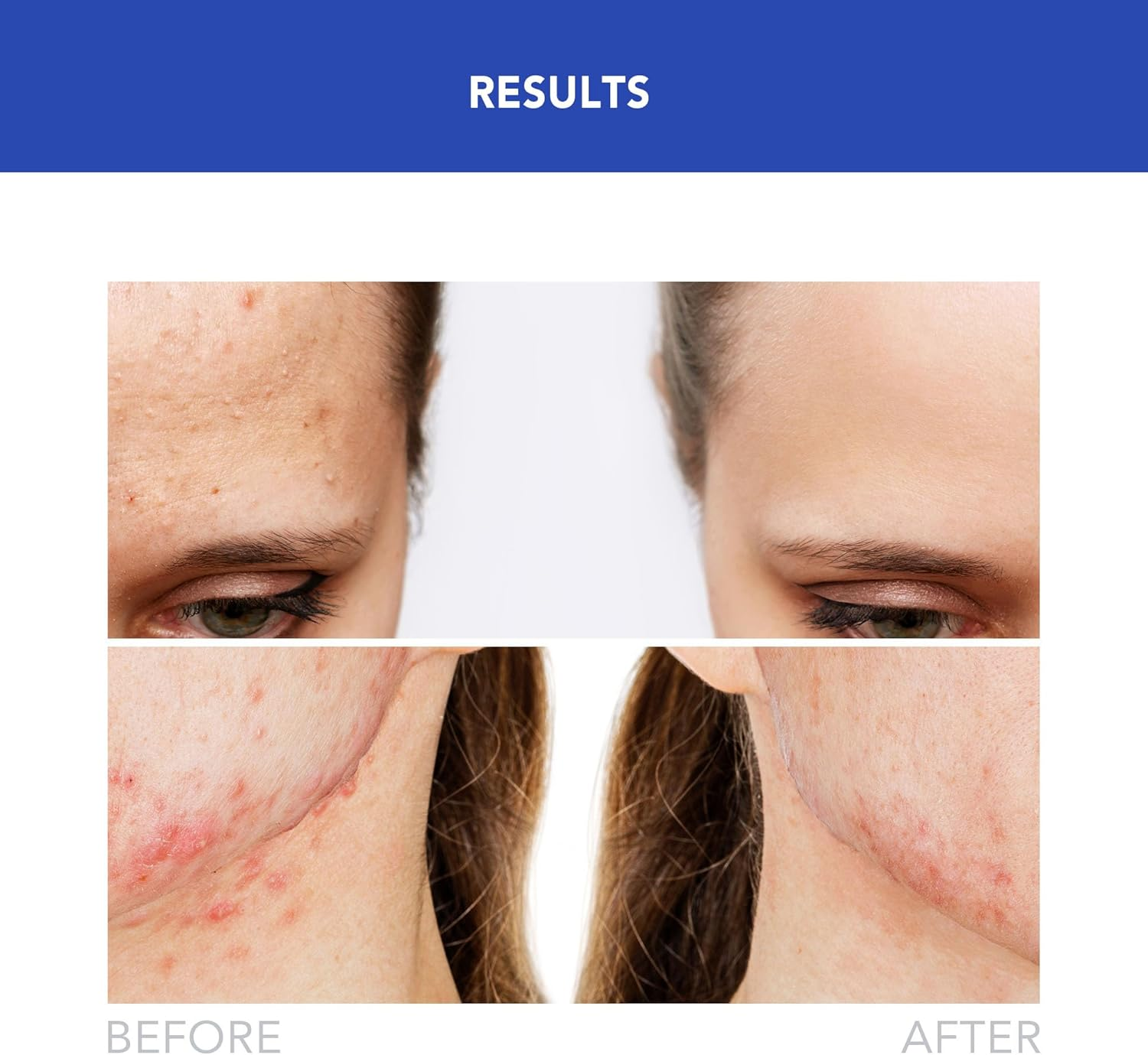 FOREO ESPADA 2 Anti-Blemish Light Skincare Device - Blemish Trace Fading - Pimple, Spot & Blemish Removal - Clear Skin - Cobalt Blue image number 4