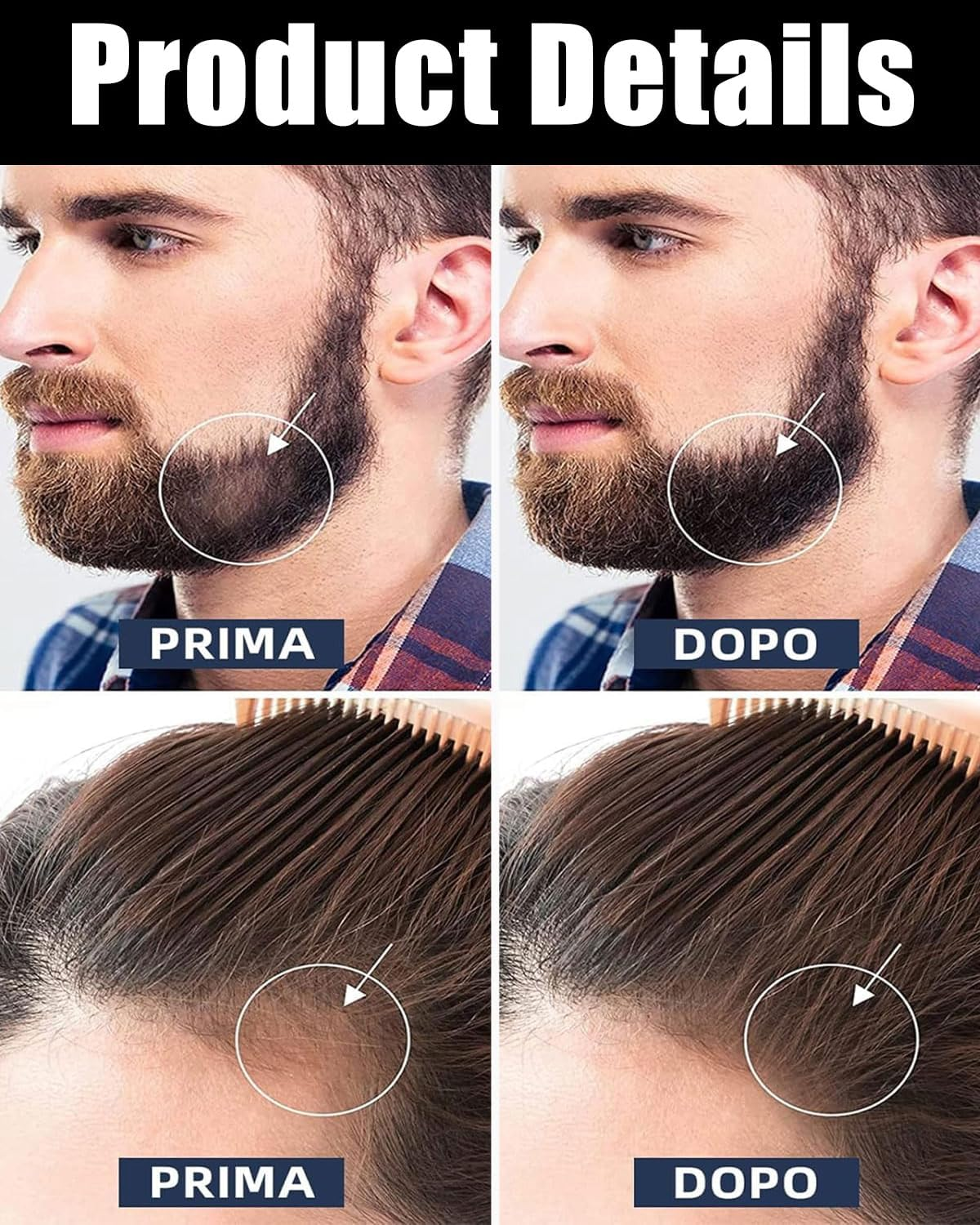 IPNSDON Beard Roller 0.5 Mm, Derma Roller, Beard Roller, Stimulates Beard and Hair Growth, Needle Roller Skin and Hair Men and Women, Reduces Acne Scars and Stretch Marks, Hair Growth Promoting image number 1