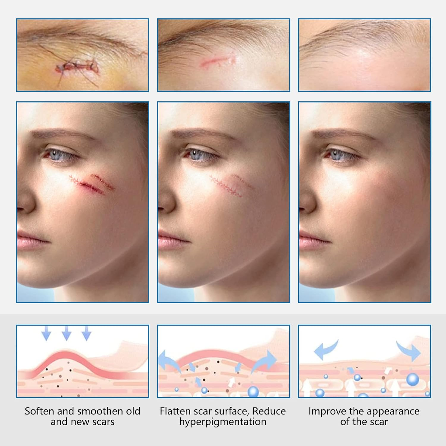 Clear Silicone Scar Sheets for Face & Body &ndash; Medical-Grade Silicone Gel, Improves & Heals Scars, Waterproof, Breathable, Easy to Cut (Roll Size 0.98" X 59", 2.5Cm X 1.5M) image number 1