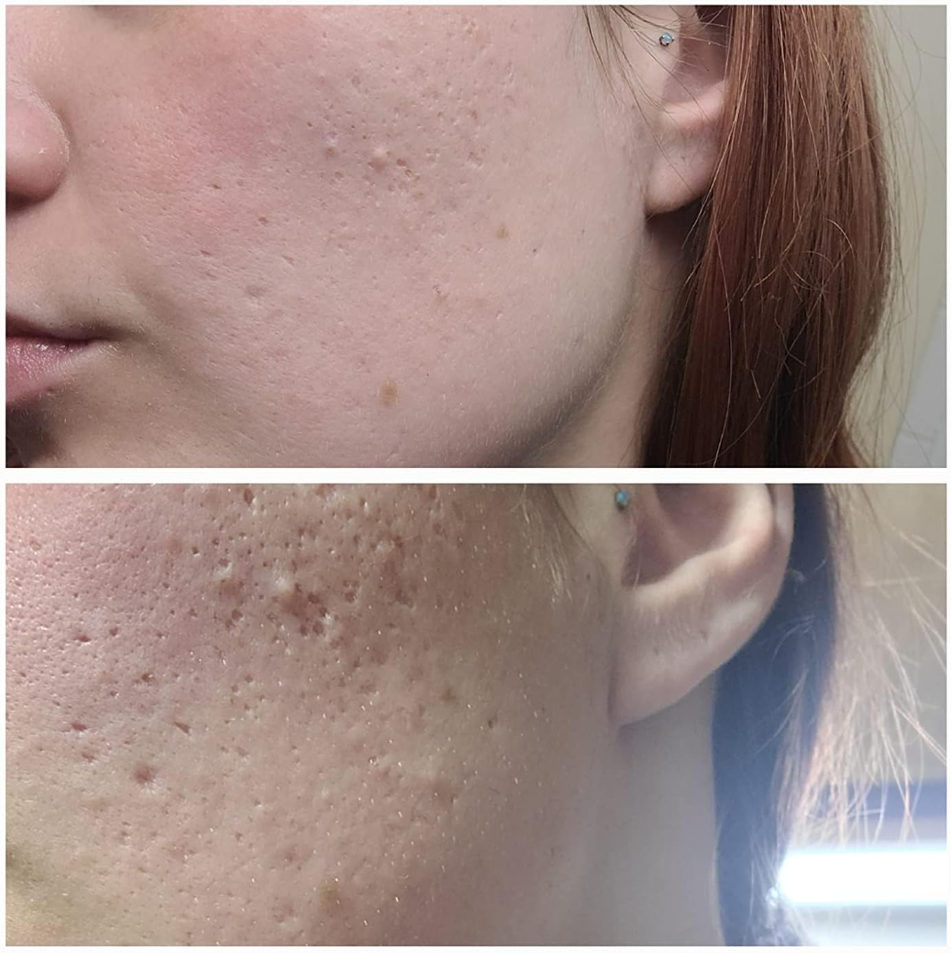 Tcatherapycare Gel Peel 25% (Professional Skin Peel) - (Level 2 Ph 1.9) - Exfoliating Face Peel &ndash; 1 Fl Oz/30Ml image number 1