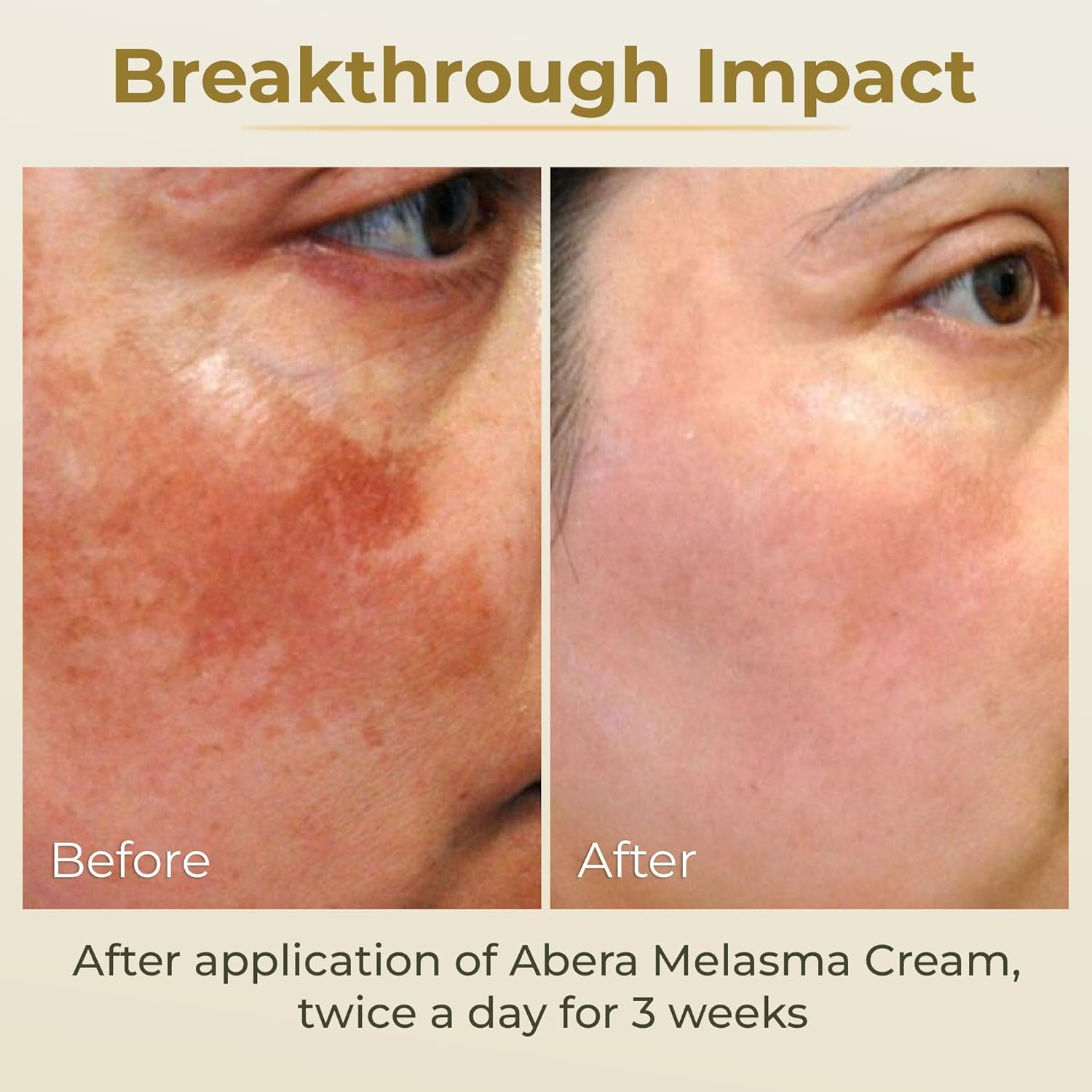 ABERA Melasma Cream (Premium Version) - Dark Spot Corrector, Melasma, Freckle, Sun Spot, Age Spot Remover Advanced Formula for Women and Men (0.7 Oz per Item) image number 2