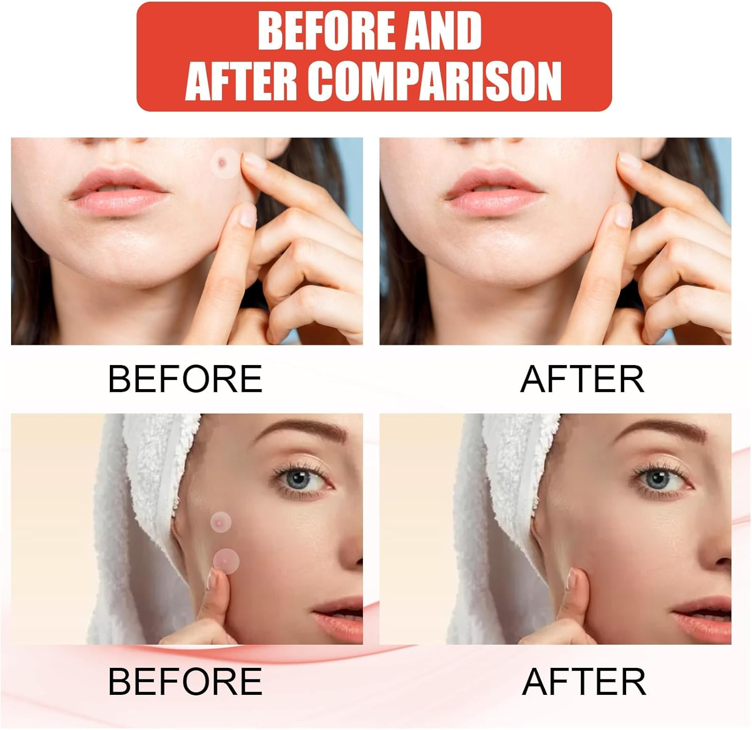 2*144 Pcspro Micro-Darts Tag-Gone Patch,Professional Micro-Dart Pimple Patches,Skin Tag Removal Patch for All Skin Types,Micro-Needle Patches,Skin Tag Remover Patches,Pimple Patches Micro-Needle image number 2