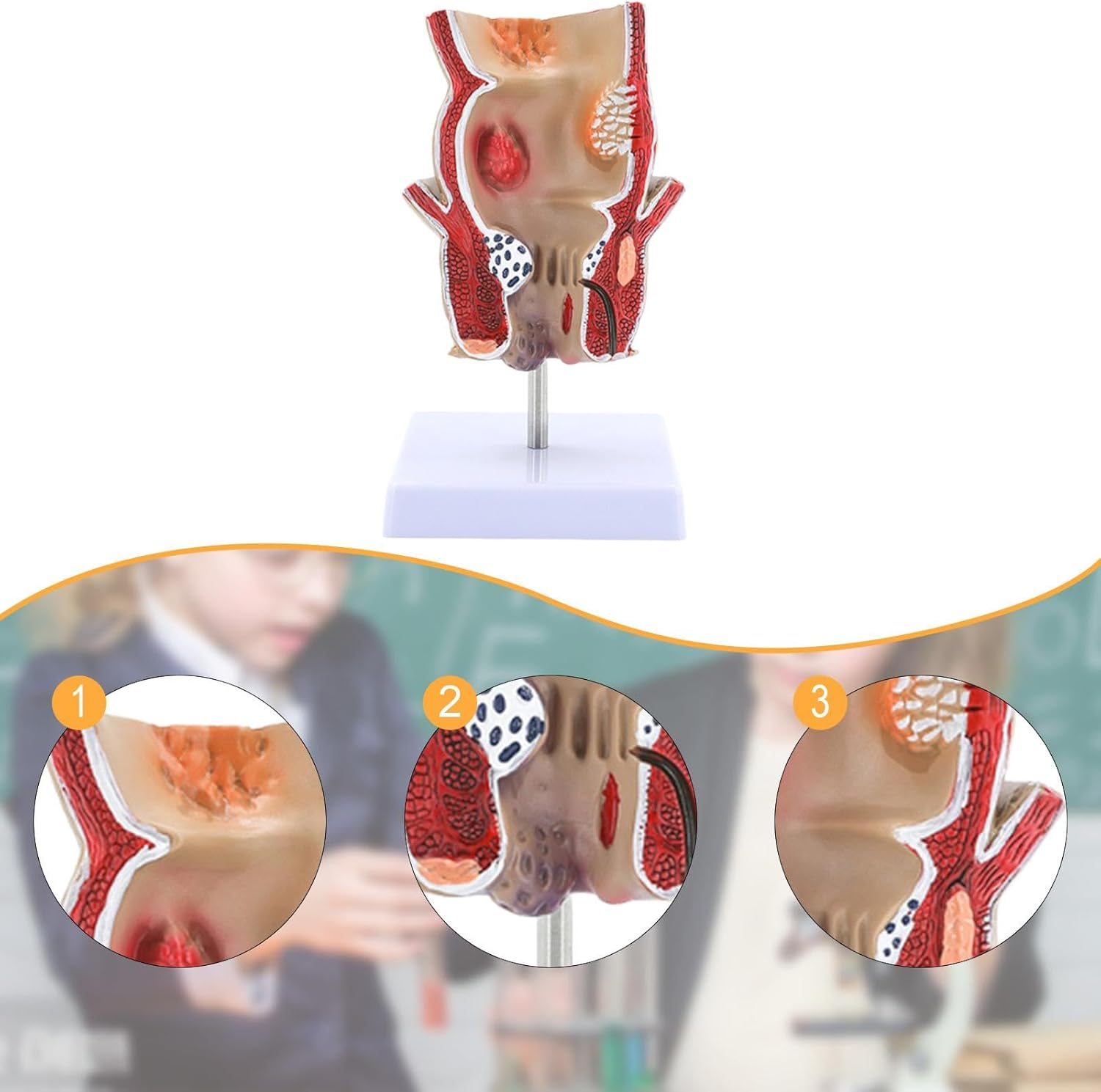 Eigell Human Pathology Rectal Model Educational Display Tool for Study School image number 6