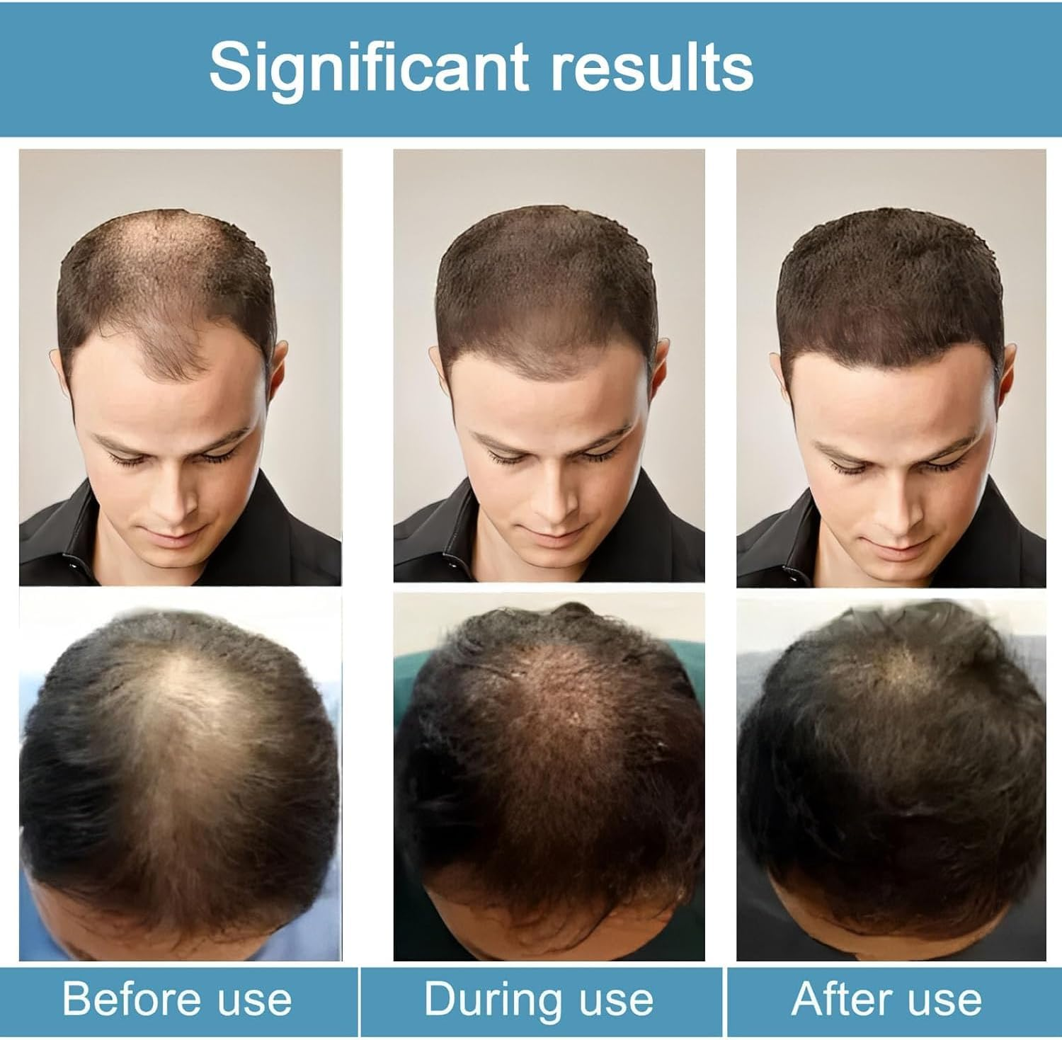 Alphainfuse Hair Regrowth System, Advanced Hair Growth Treatment, Gentle Painless, Strengthens Roots for Men and Women (2Pcs) image number 1