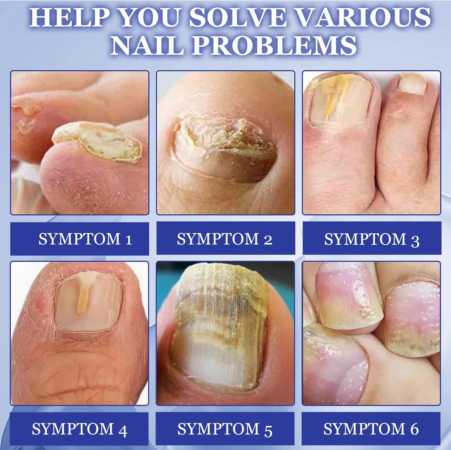 3 Packs of Toenail Treatment, Nail Digging Repair Patches, Split Nail Repair Strengthening Nails, Nail Digging Repair Plasters for Damaged Nails and the Appearance of Discoloured Nails image number 6