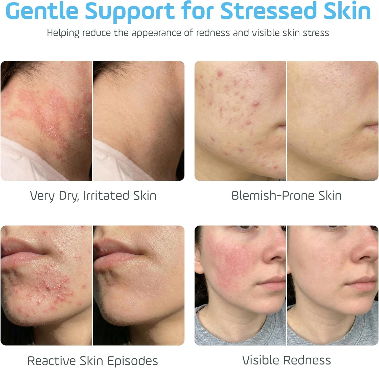 Hypochlorous Acid Facial Spray | Hocl Hydrating Skin Mist for Sensitive & Redness Prone Skin | Soothing Face Toner Alternative, Daily Refresh & Post Workout Mist 60Ml image number 1