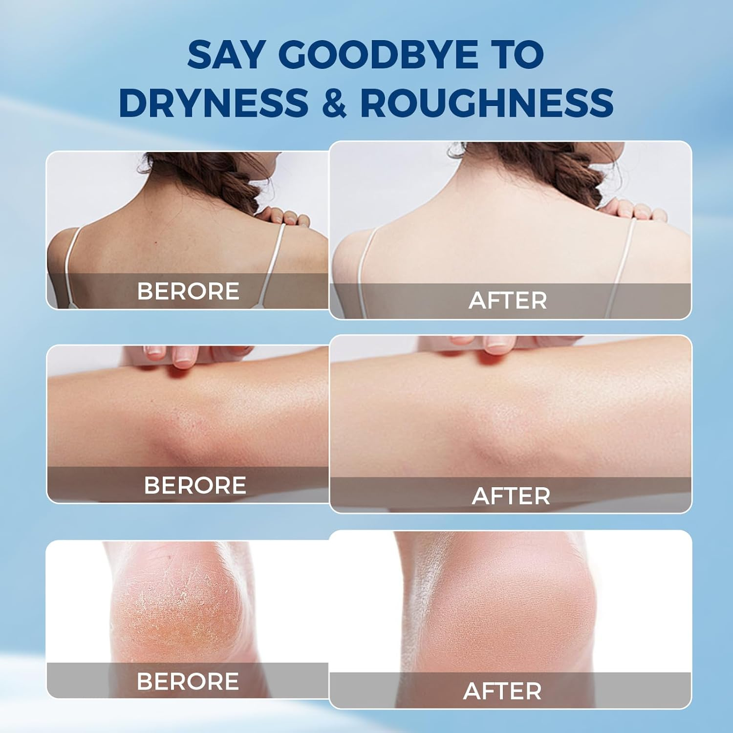 OUKEYA Urea Cream 40 Percent for Feet Maximum Strength, Hand Heels Dry Cracked Treatment Lotion for Knees & Elbows, Foot Dead Skin Cuticle Callus Remover Toenail Softener, 5.29 Oz image number 4