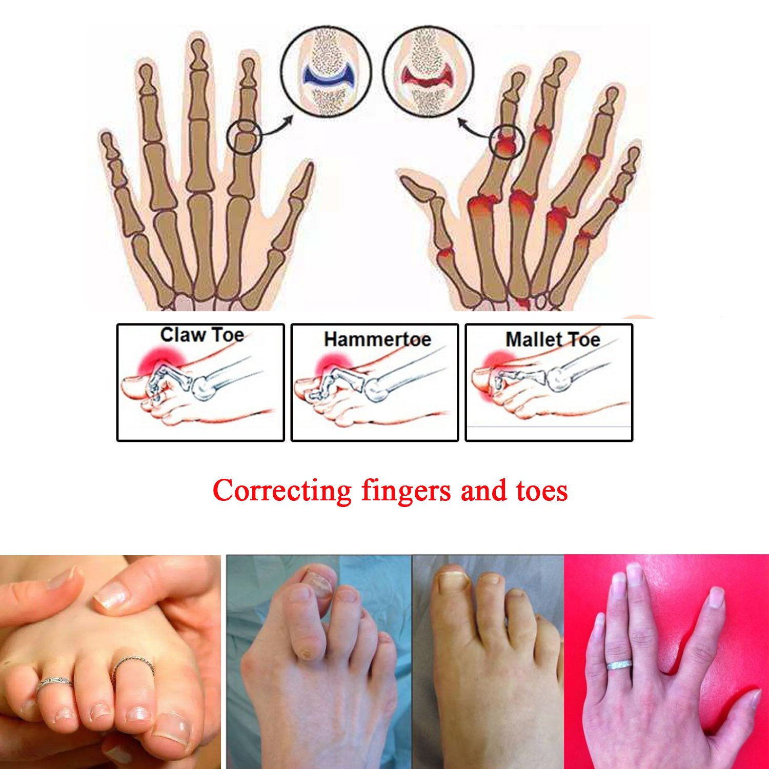 Broken Toe Separator Wrap 4 Pieces Hammer Toe -Toe Straightener, Cushioned Bandages- Elastic Toe/Finger Tape for Overlapping Toes, Sprained, Swollen, Dislocated, Fractured, Mallet