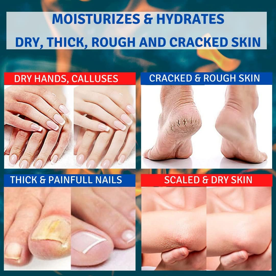 TIS Urea Cream 30% - Eczema, Keratose, Psoriasis, Skin Breakouts, Dry, Cracked Skin - Helps Improve the Appearance of Wounds and Scars | Lactic Acid (AHA), Wheat Germ Oil - Pack of 2 image number 1