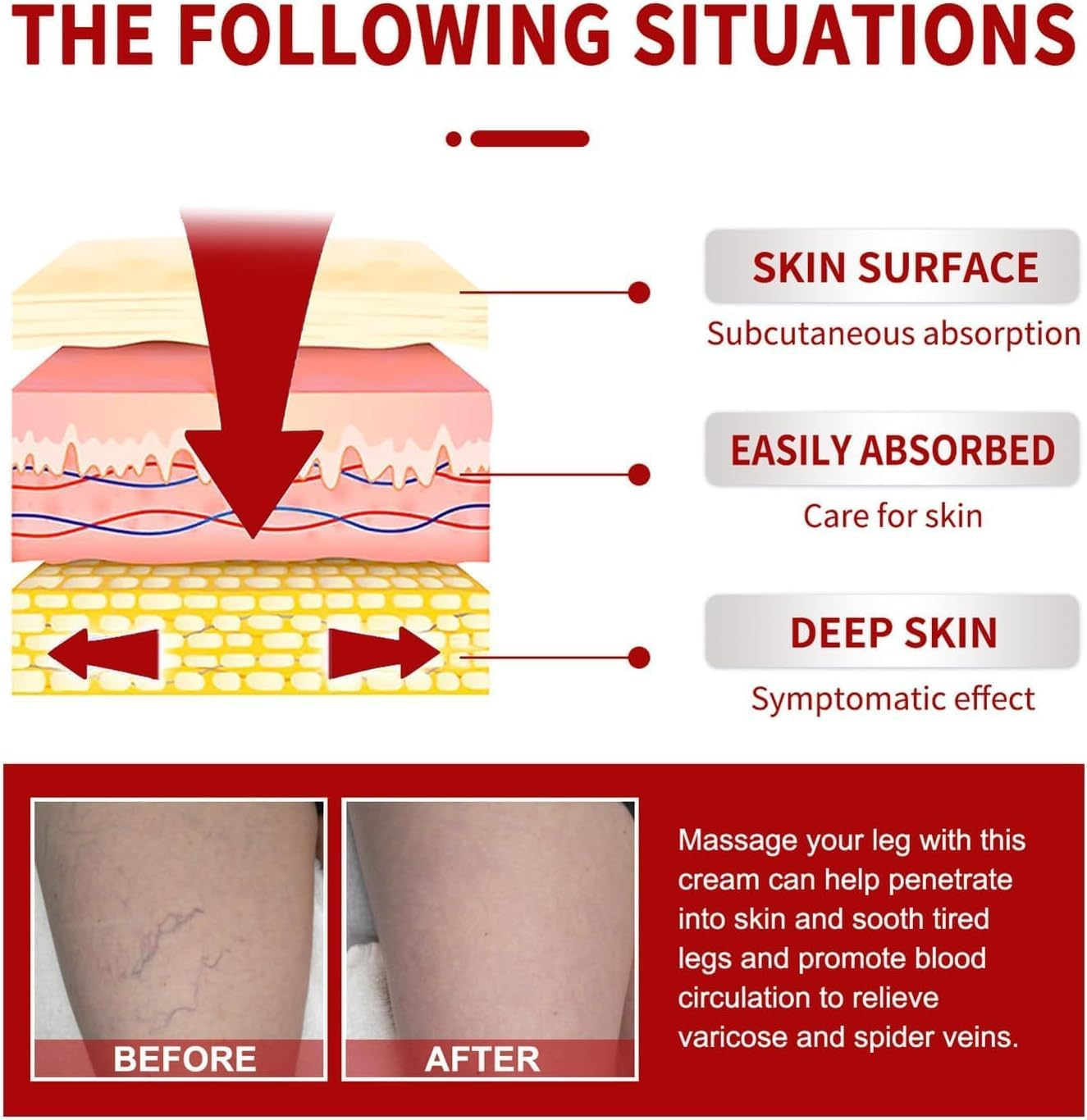 3 Pcs Medilisk Cream Varicose Veins,Medilisk Varicose Veins Relief Cream,Varicose Veins Treatment for Legs,Remove Varicose Veins, Improves Blood Circulation image number 5