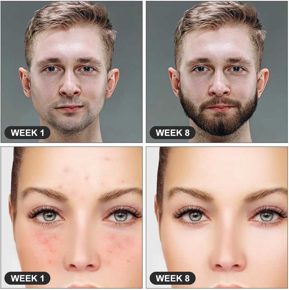 LOPHE Derma Roller, 0.25Mm Microneedle Derma Roller for Men and Women, Professional Microneedling Derma Needling, Micro Needle Roller Facial Wrinkles Hair Loss Stretch Marks Hair Regrowth