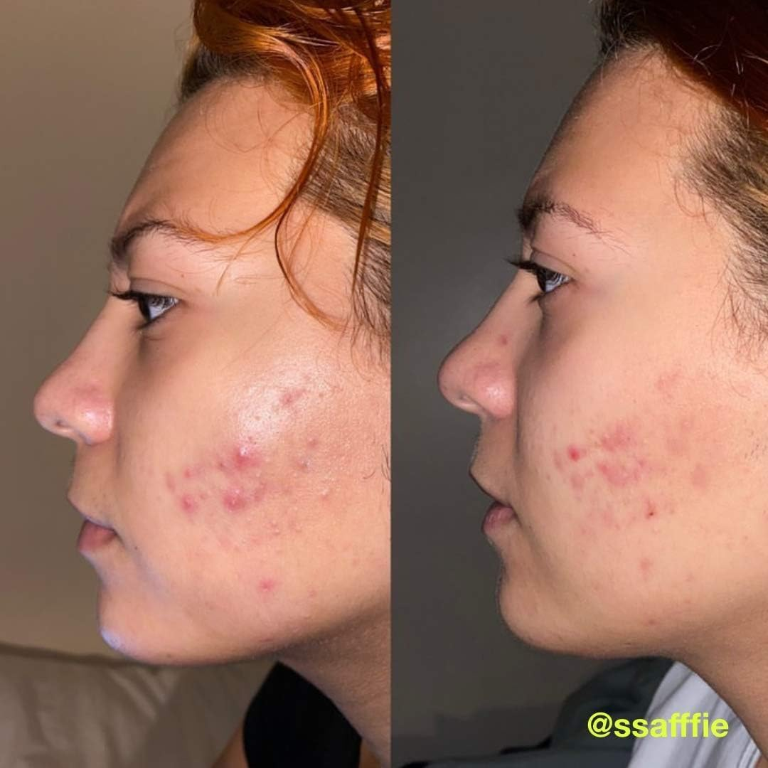 Carbon Theory | Charcoal, Tea Tree Oil & Vitamin E Breakout Control Overnight Detox Facial Serum | Natural, Vegan and Cruelty Free | 30Ml image number 1