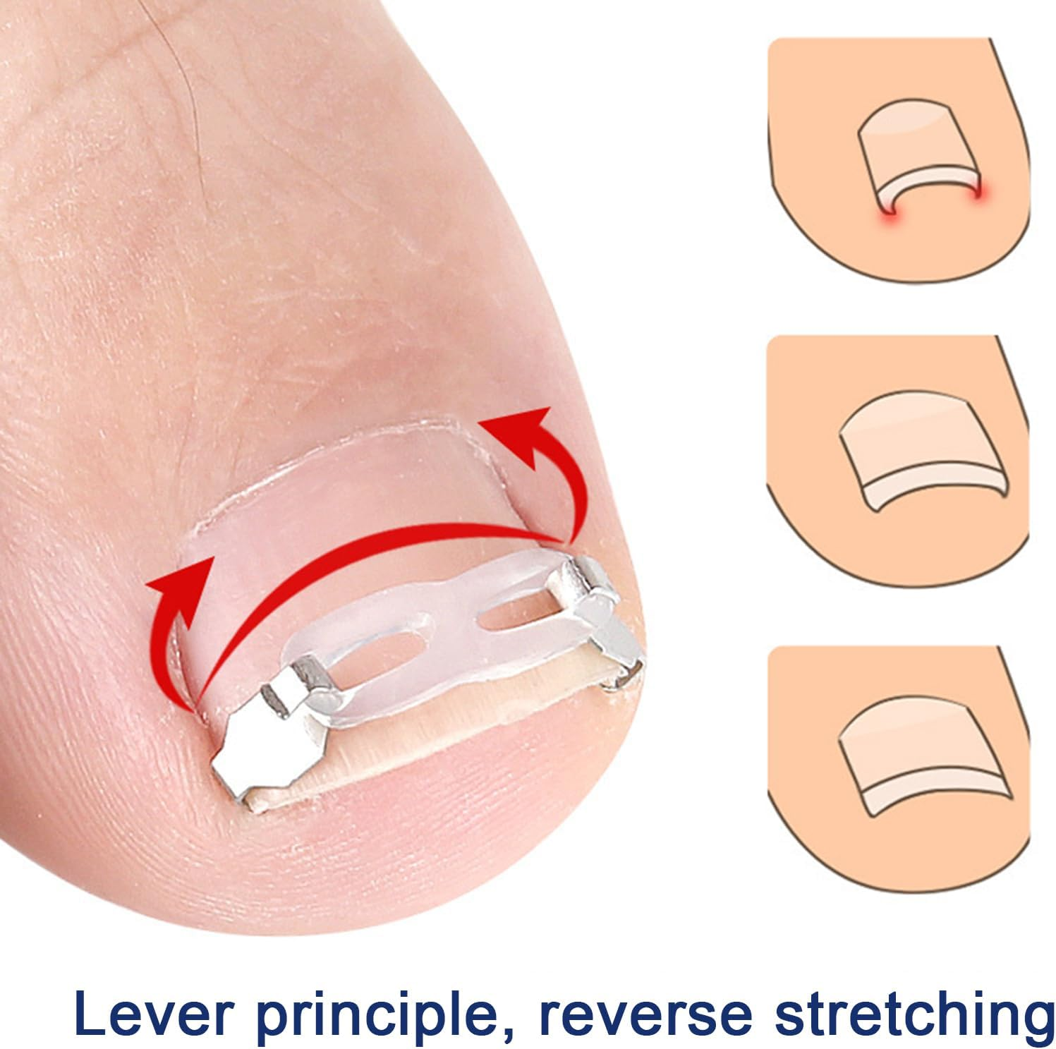 Nail Corrector Patch | Renewal Ingrown Toe Nail Stickers - Breathable Toenail Straightening Tool for Adults Family Friends Foot Care Accessories image number 5