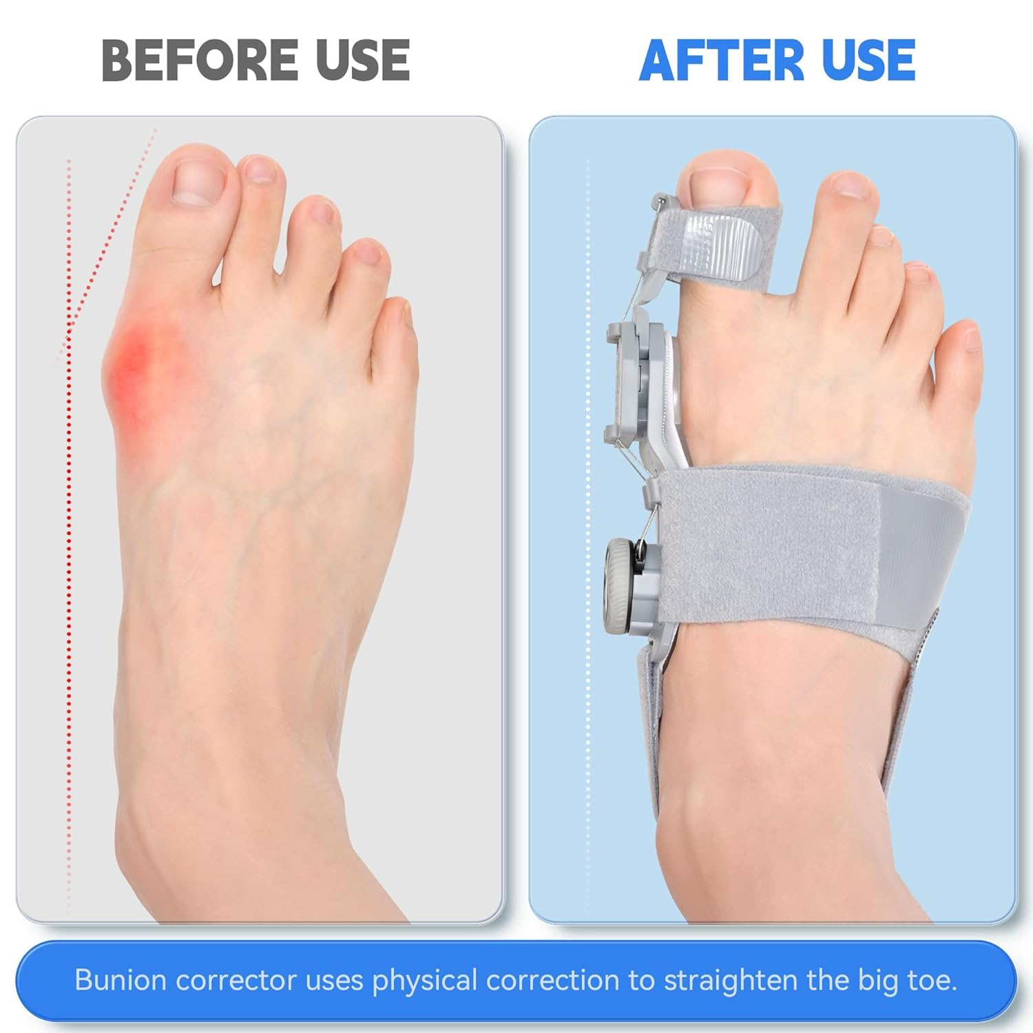 Bunion Corrector for Men & Women, Adjustable Bunion Splint, Big Toe Straightener Pain Relief, Suitable for Left/Right Foot Bunion (1Pcs,Gray) image number 6