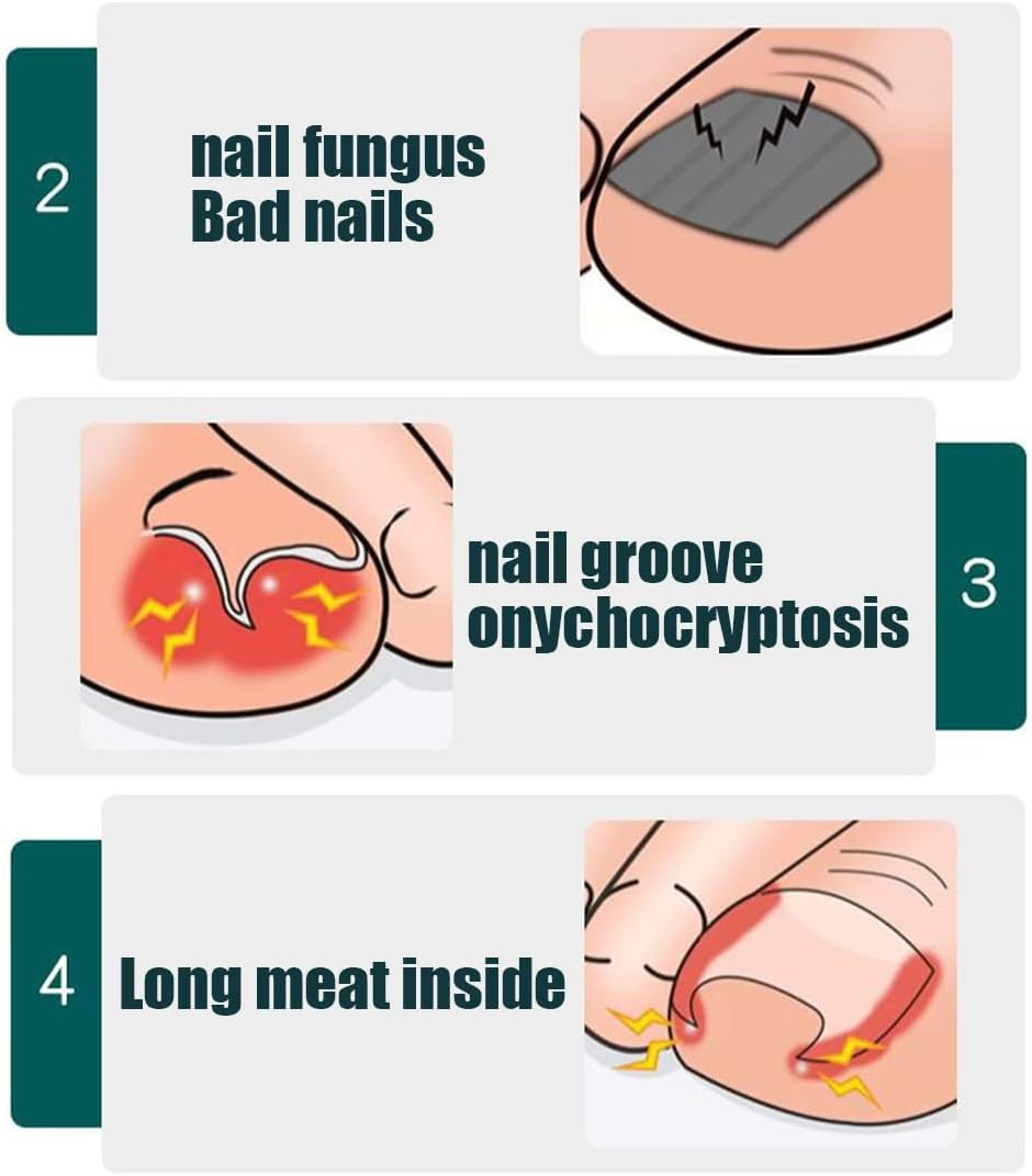 GXGM Professional Toenail Pliers Set, Stainless Steel Toenail Nail Scissors Set Toenails Pedicure Set with Nail Clippers for Thick Ingrown Hard Toenails Paronychia Onychomycosis (Red) image number 4