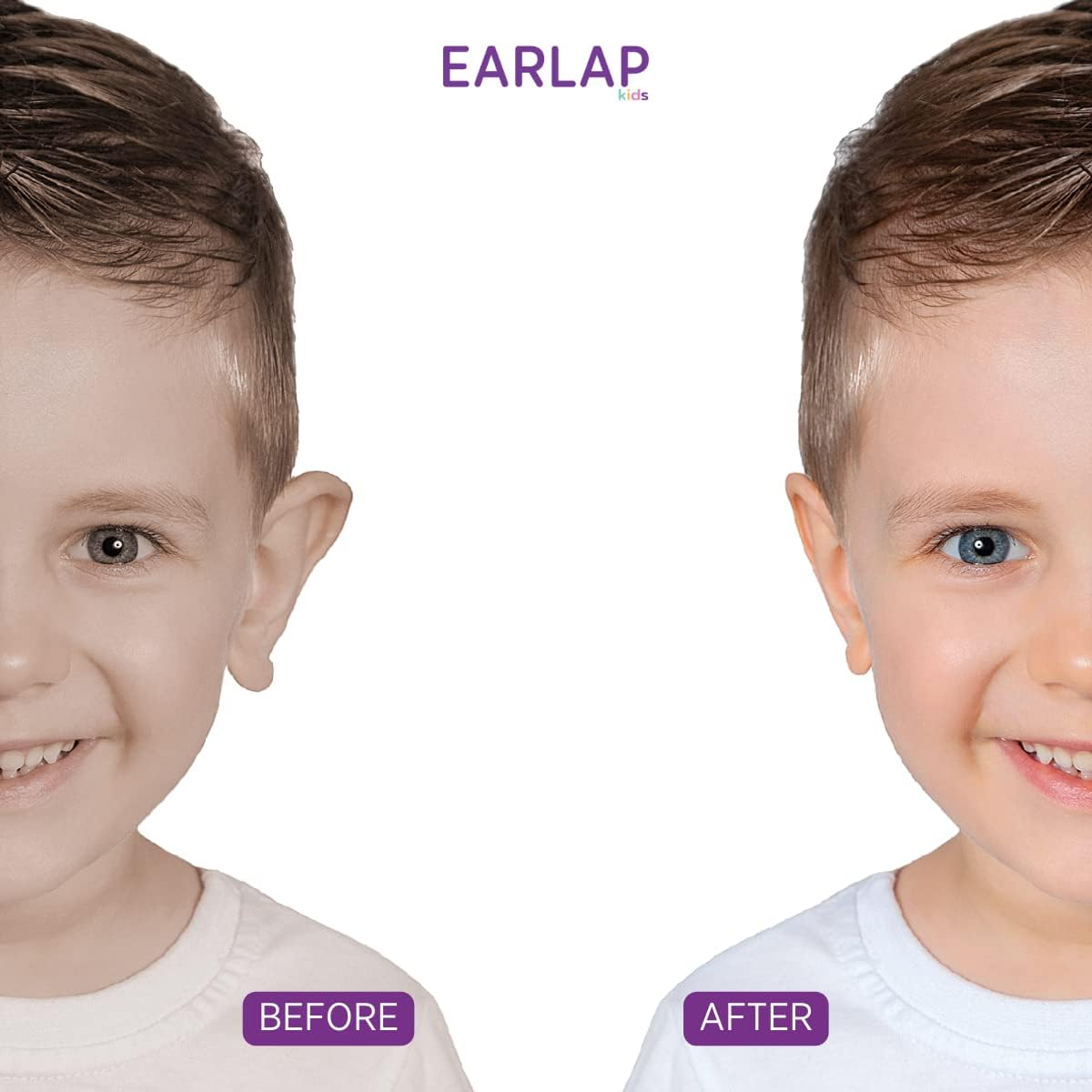 Beauty Tapes Kids Ear Corrector for Kids (12-72 Months), Protruding Ear Sticker, Protruding Ear Pinning without Surgery, Permanent Corrective Effect, Contains 20 Kids Corrector, 10 Solaps image number 3