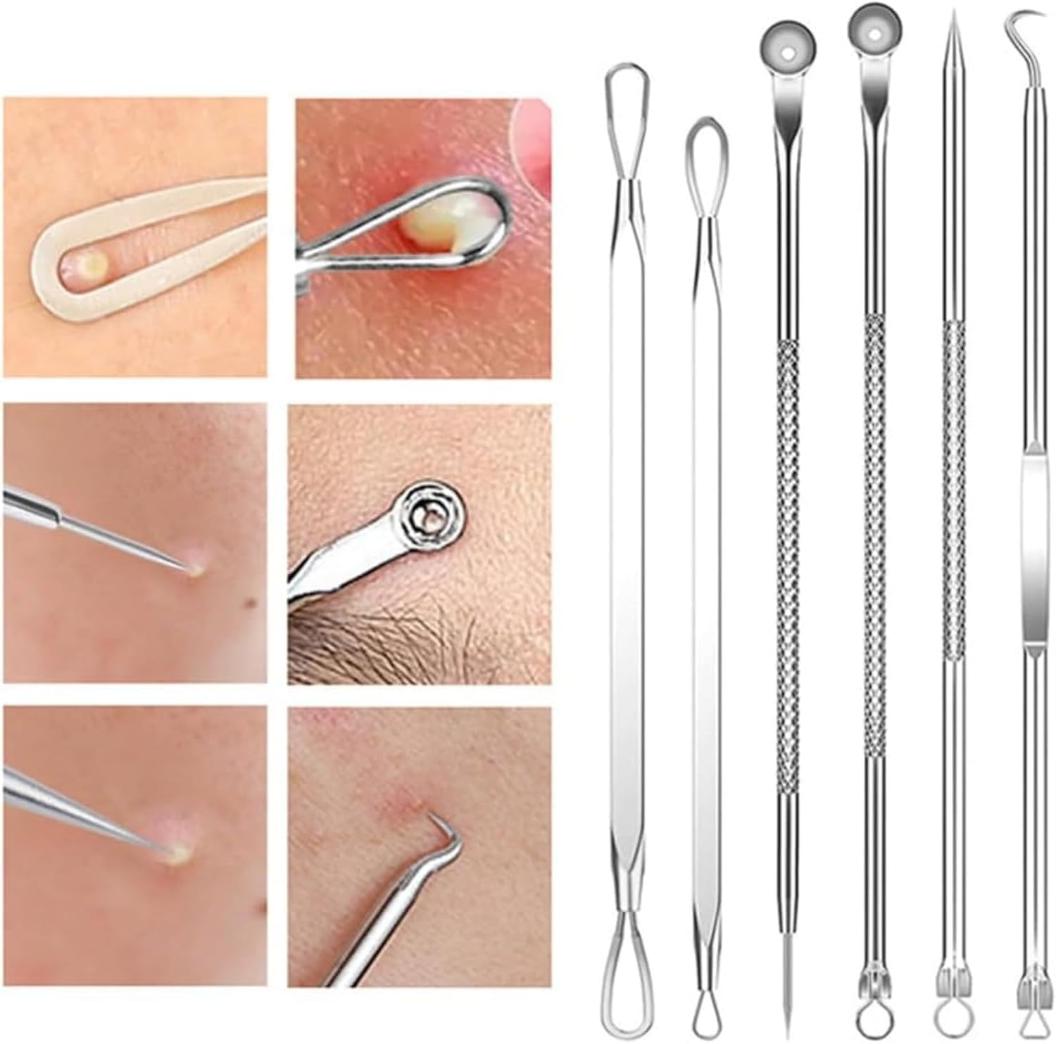 RODISHOMM 15-Piece Blackhead Remover Set - Pimple & Comedone Extractor, Acne & Whitehead Removal Tools, Premium Stainless Steel, Includes Silver Metal Case image number 1