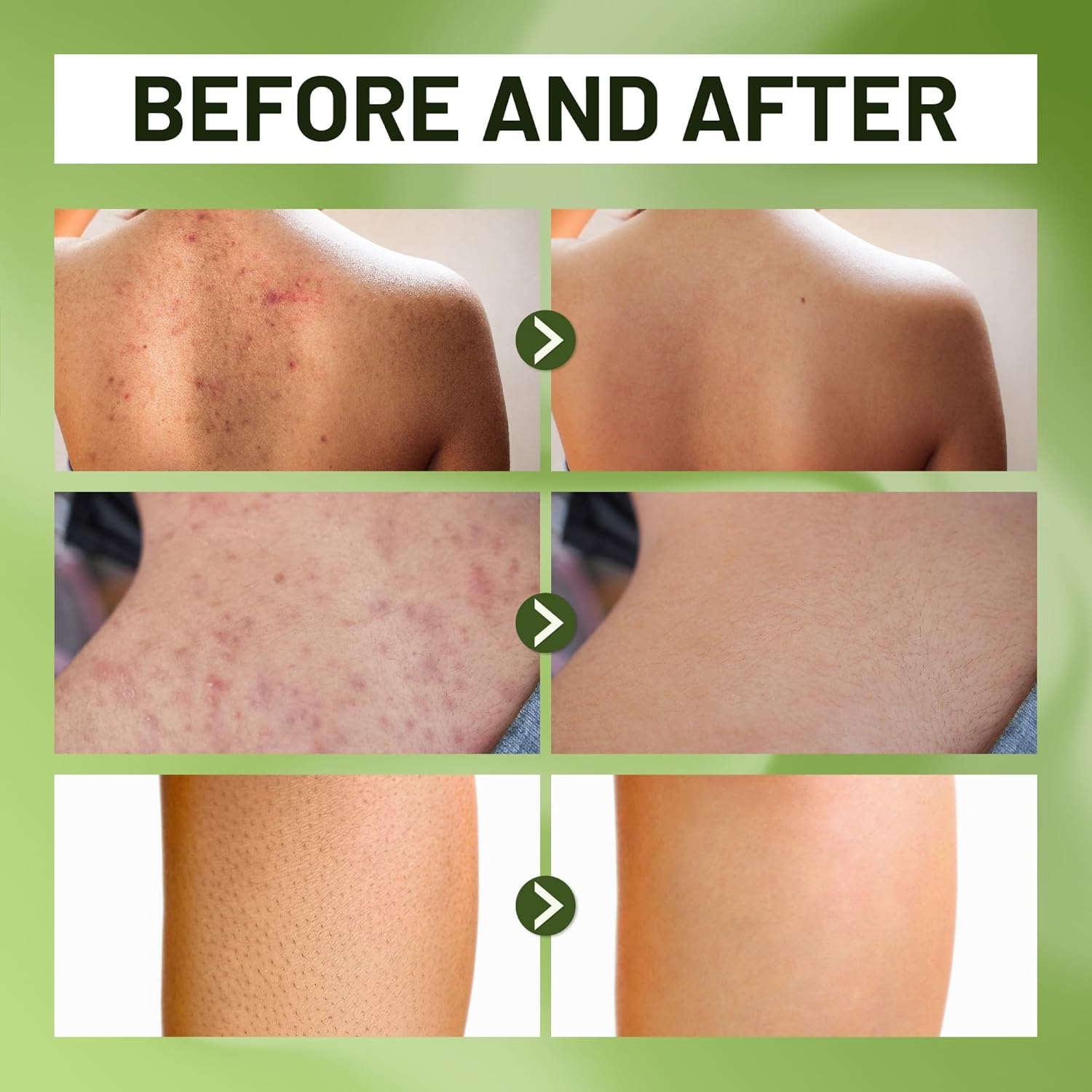 ABERA BHA Body Wash for Folliculitis & Body Acne &ndash; Wild Bitter Melon Extract, Exfoliating Shower Gel for Clear & Smooth Skin, 300Ml image number 2