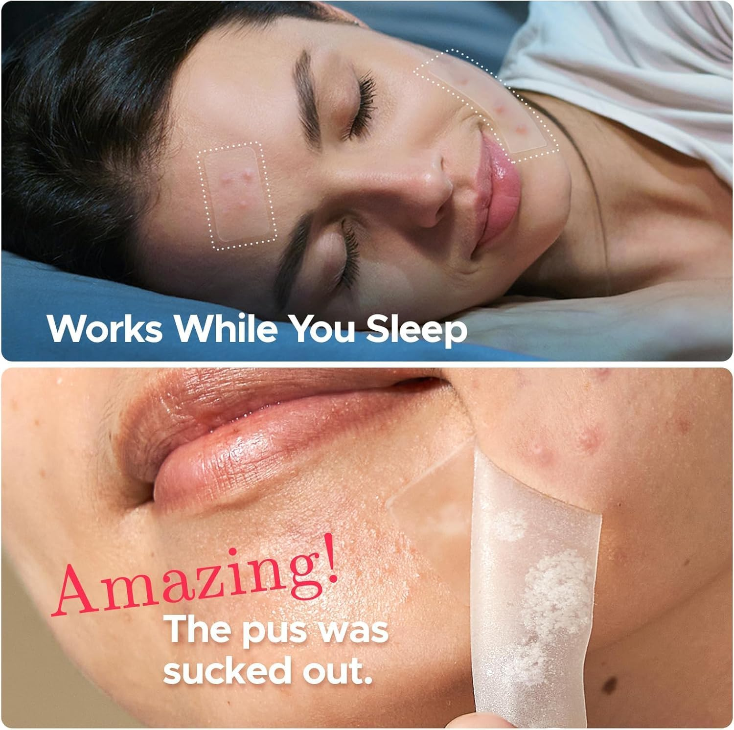 Litbear Large Pimple Patches, 5 Sizes 156 Patches Big Acne Patch, 60 XL Hydrocolloid Patch for Full Face, Forehead, Chin, Nose, Body, Back, Neck & Chest, Stirp, Square Large Hydrocolloid Bandages image number 1