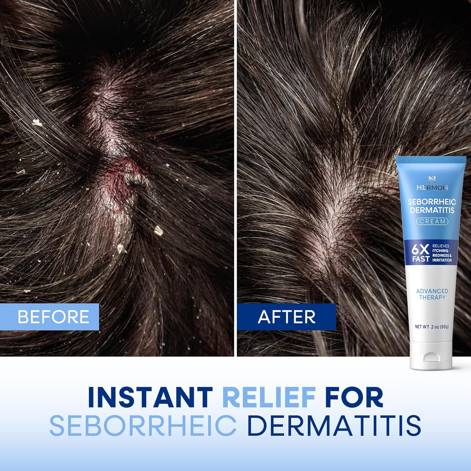 Hermon Seborrheic Dermatitis Scalp Treatment Cream: Itchy Relief, Redness & Flaking Seborrheic Dermatitis - Fast Acting Anti-Itchy Ointment for Scalp image number 3