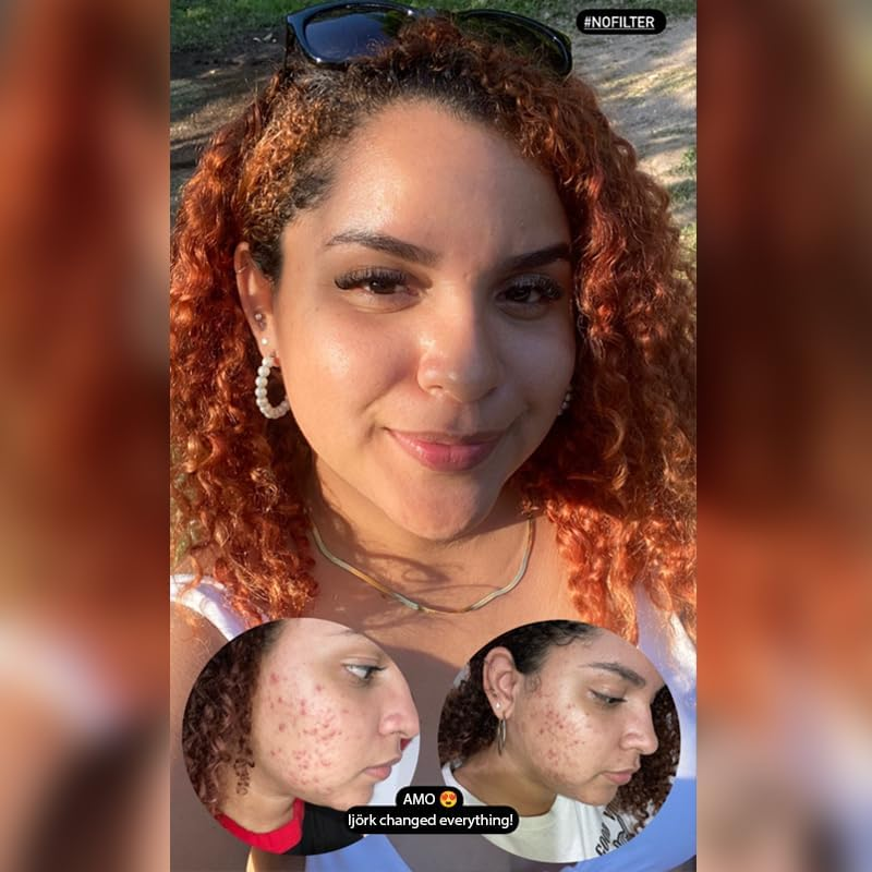 Non-Commodenic Moisturiser for Blemishes and Breackouts Prone Skin image number 1