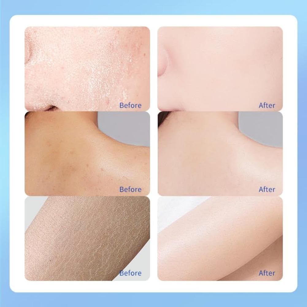 Urea Cream 40 Percent for Feet, Cream for Cracked Heel Feet Knees Hands Elbows for Dry Cracked, Moisturizer for Skin Care