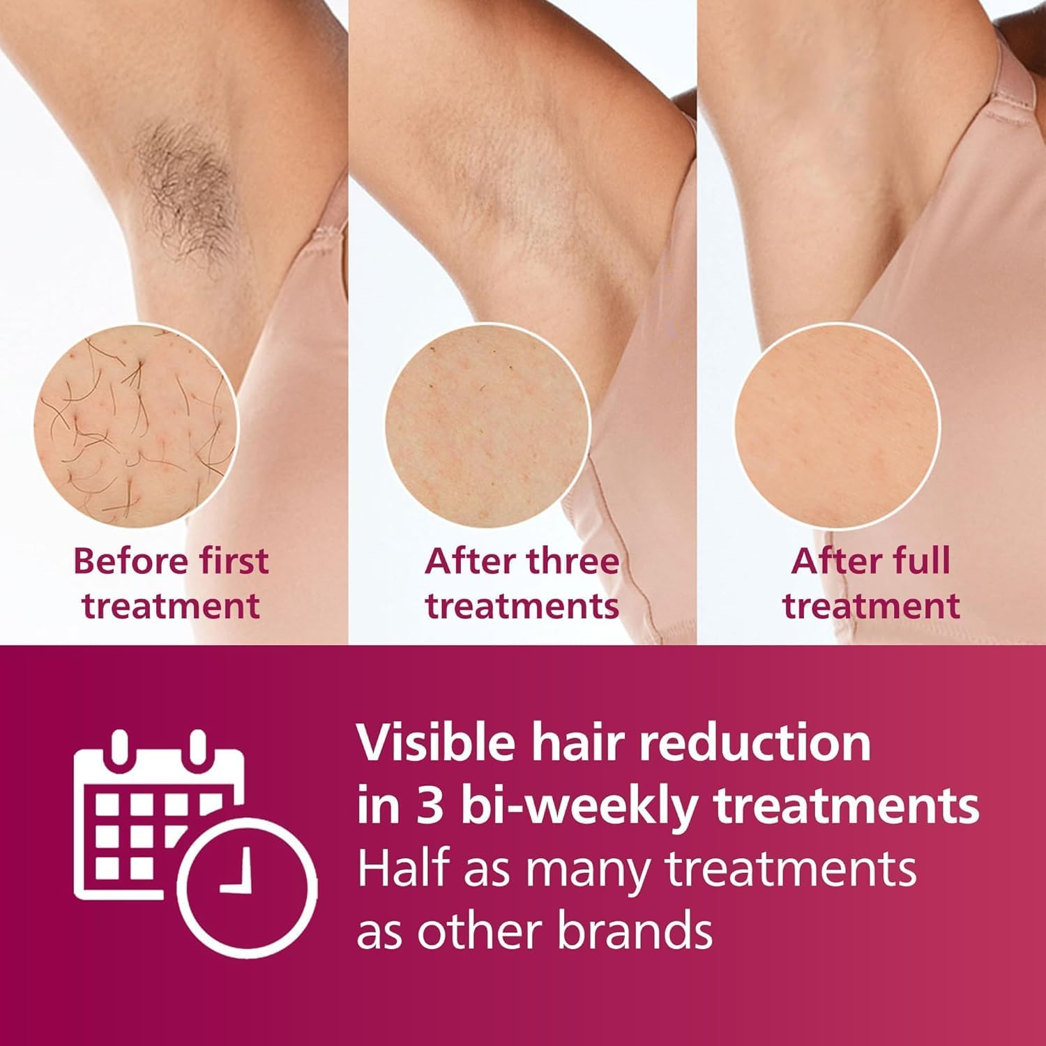 Philips Lumea IPL Hair Removal Device (AU Power Plug) with Smartskin Sensor, Body, Face, Bikini Attachments, Pen Trimmer, White, BRI923/00