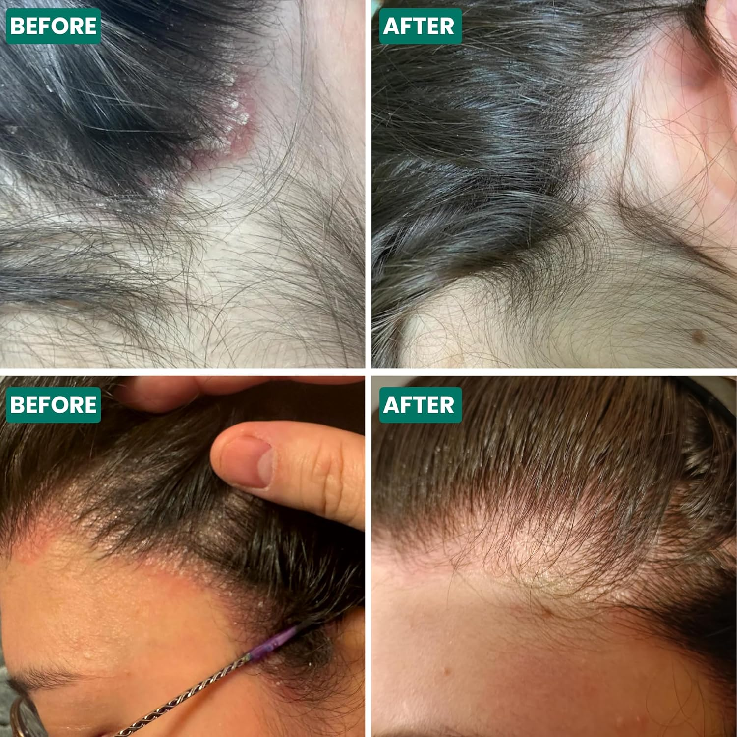 Grahams Natural Scalp Relief Oil - for Dry, Itchy & Flaky Scalp Psoriasis, Seborrheic Dermatitis & Dandruff Treatment - Hydrating, Moisturising, Exfoliating (1 X 100 Ml) image number 3