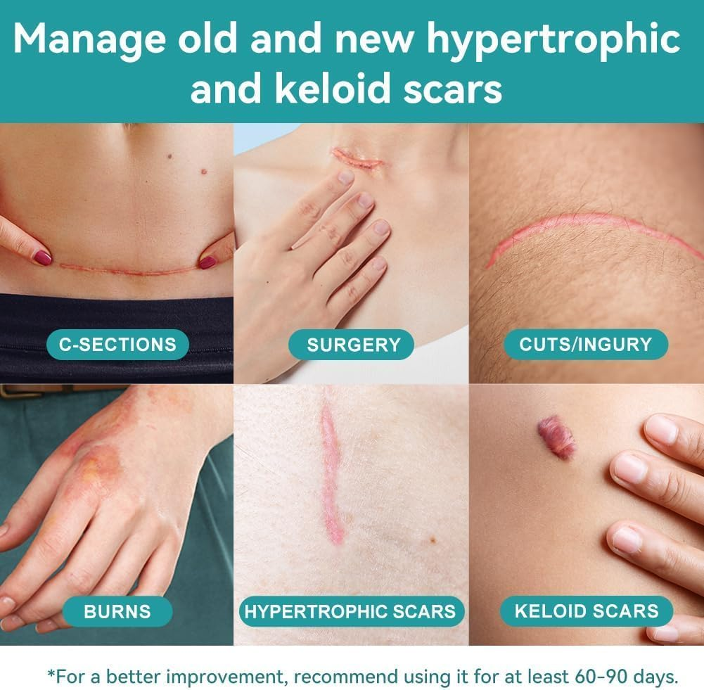 Dimora Medical Grade Silicone Scar Sheets - Ultra Soft Silicone Scar Tape (4Cmx3M), Waterproof Scar Treatment for Surgical Scars, C Section, Tummy Tuck, Keloid Treatment image number 2