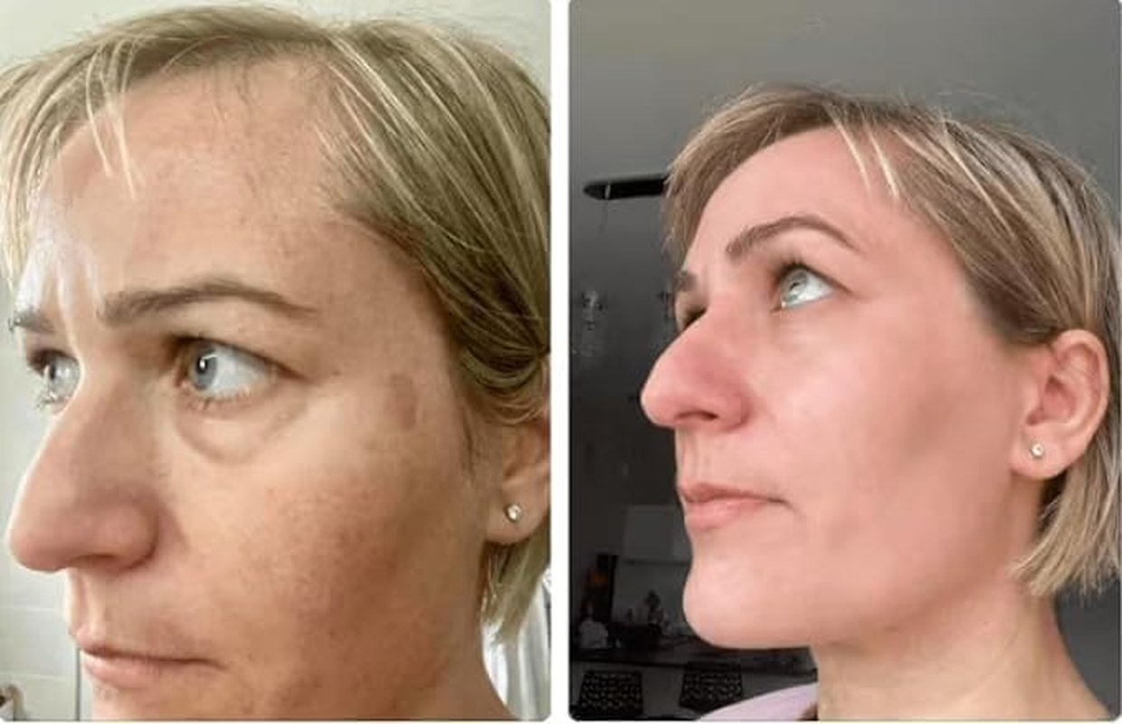 Tcatherapycare Gel Peel 60% (Professional Skin Peel) - (Level 2 Ph 1.9) - Exfoliating Face Peel &ndash; 1 Fl Oz/30Ml image number 3