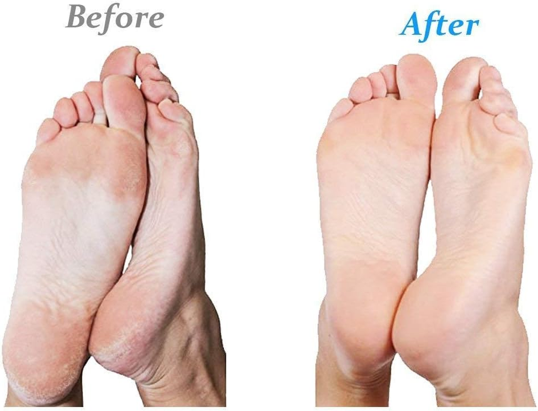 Emjoi Micropedi Battery Operated Callus Remover image number 1