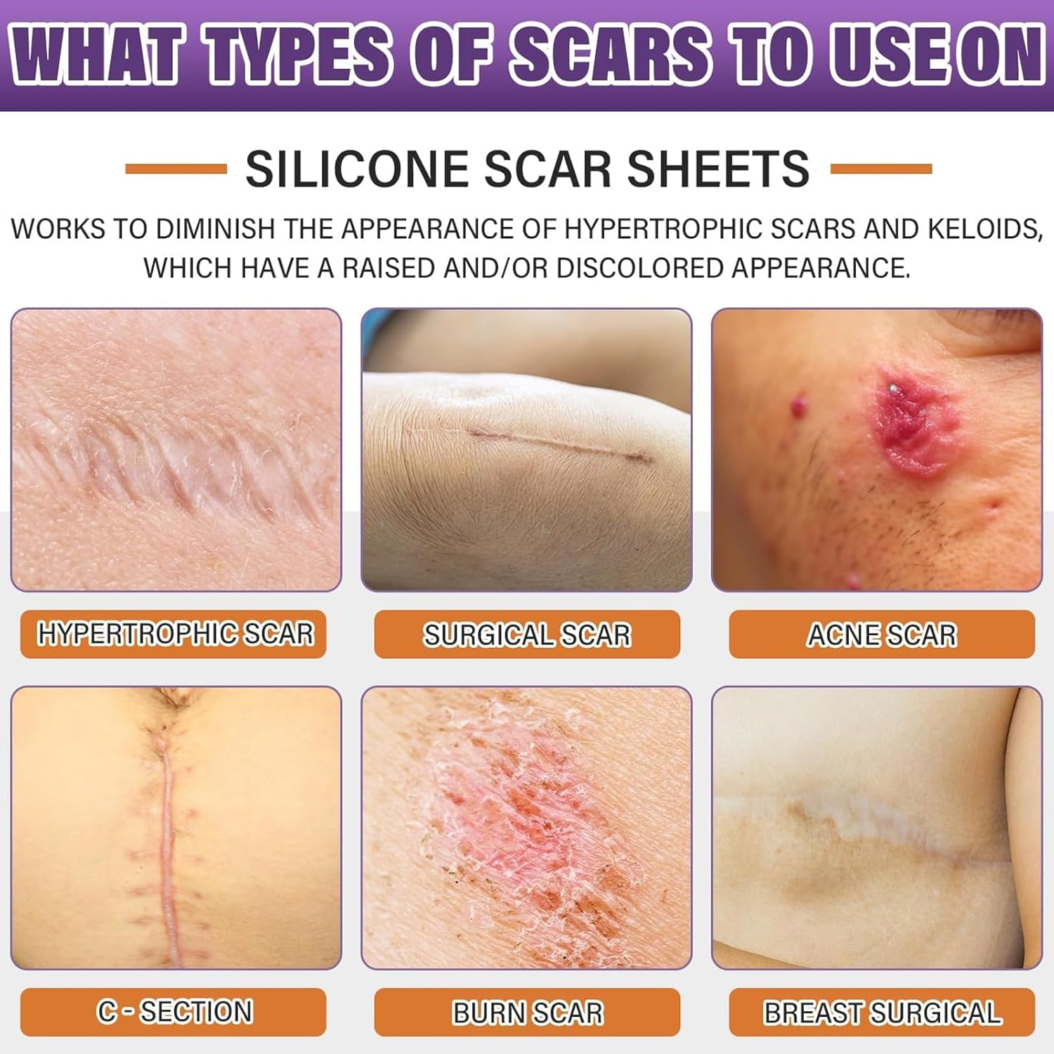 Silicone Scar Sheets, Silicone Scar Tape Strips(4X150Cm), Professional Away Sheets for Surgical Scars, Keloid, C-Section, Burn Et image number 6