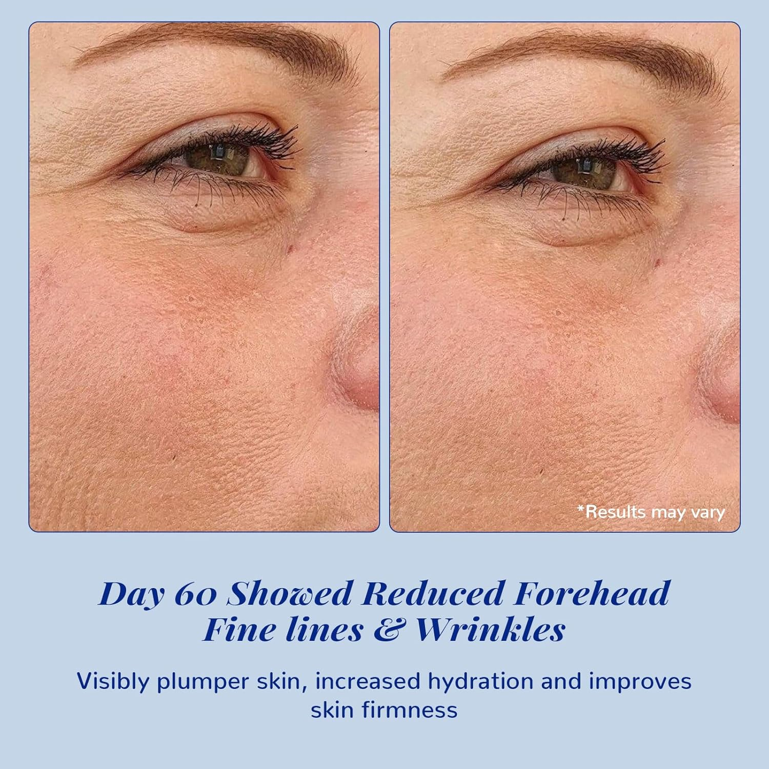 ANAI RUI Matrixyl 3000 + Argireline Serum with Hyaluronic Acid - Reduce Fine Line - Facial Skin Serum 1.05 Fl.Oz