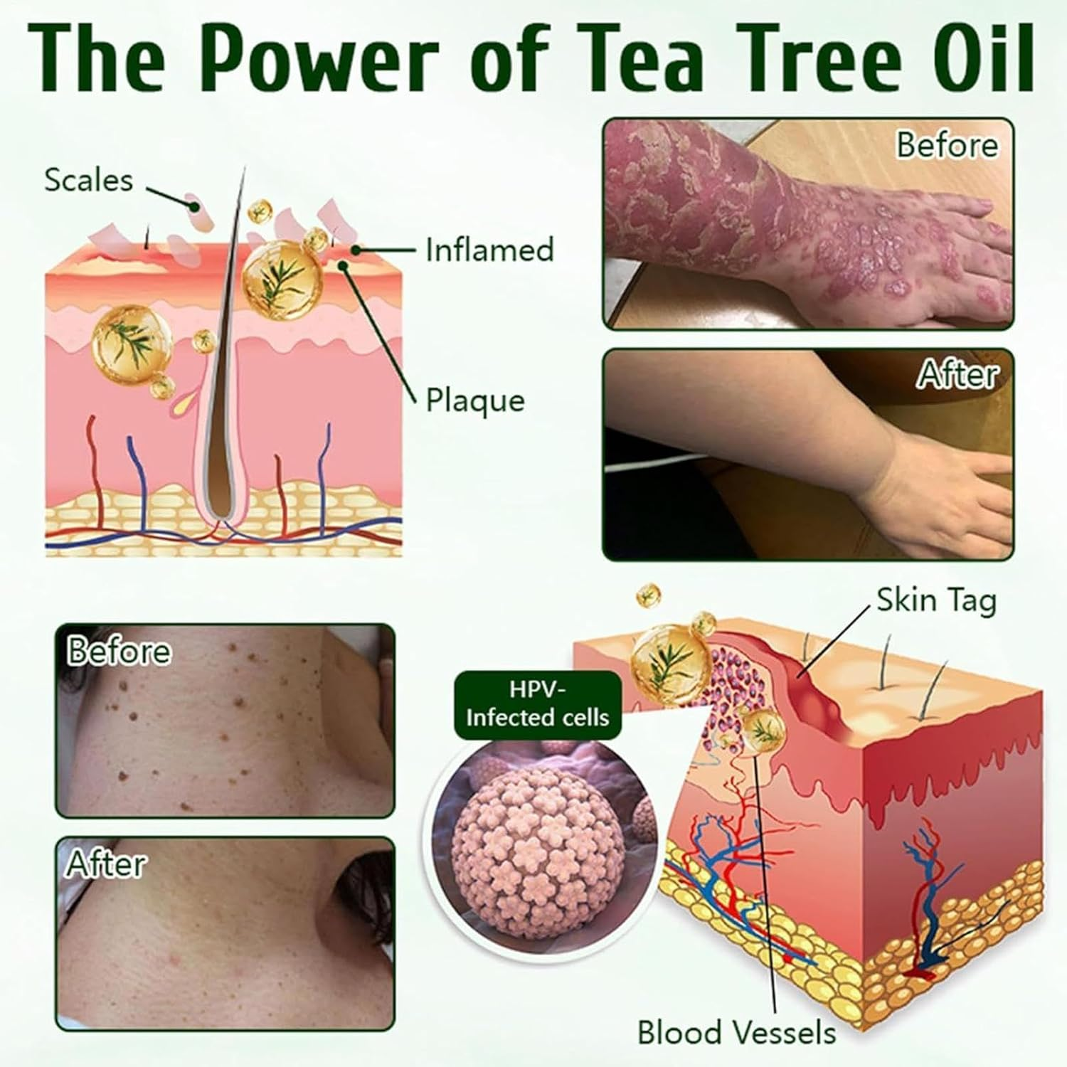 Organic Tea Tree Oil Cream,Non Greasy Gentle Moisturizing Gel,Natural Cosmetics for Blemished Skin,Professional Tea Tree Skin Repair Cream