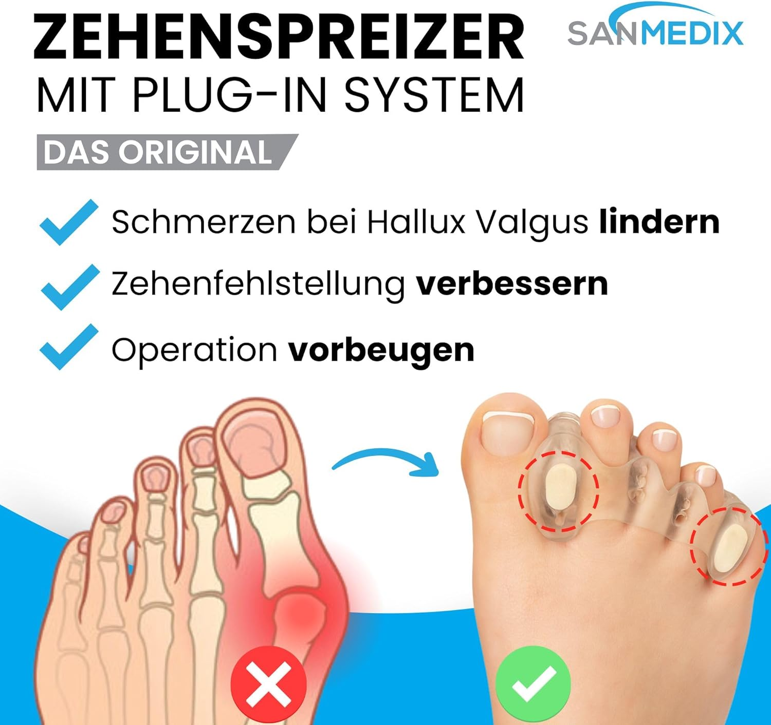 Sanmedix Toe Separators - 2 Pairs Toe Separators with Plug-In System for Hallux Valgus, Bunion & Toe Correction - Silicone Toe Spacer for Men and Women (Transparent, One Size)