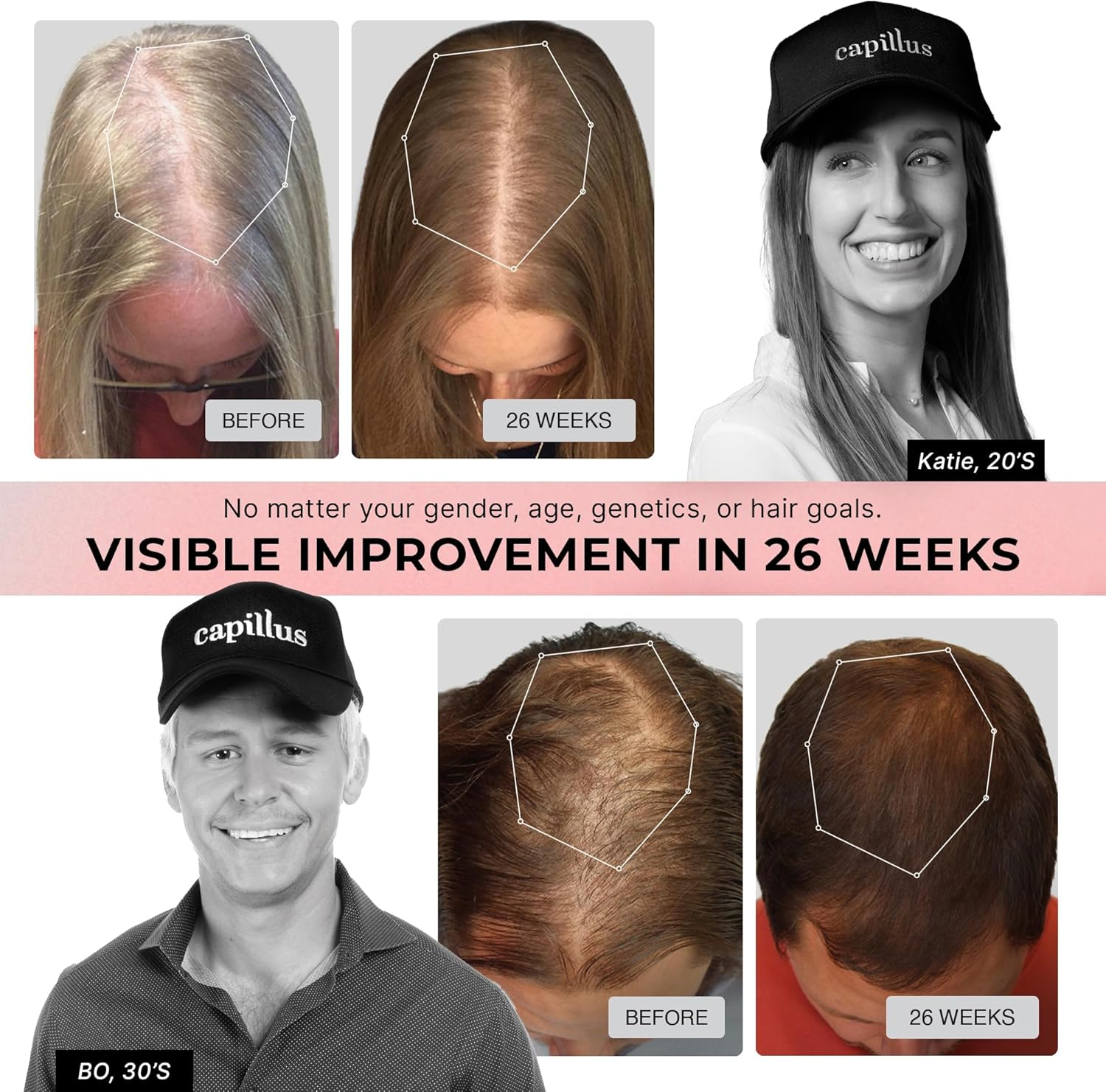 Capillus Pro S1 Red Light Therapy for Hair Growth Hair Red Light Therapy Red Light Cap for Hair Regrowth, 304 Laser Cap for Hair Regrowth Red Light Hair Therapy Laser Hair Growth Cap