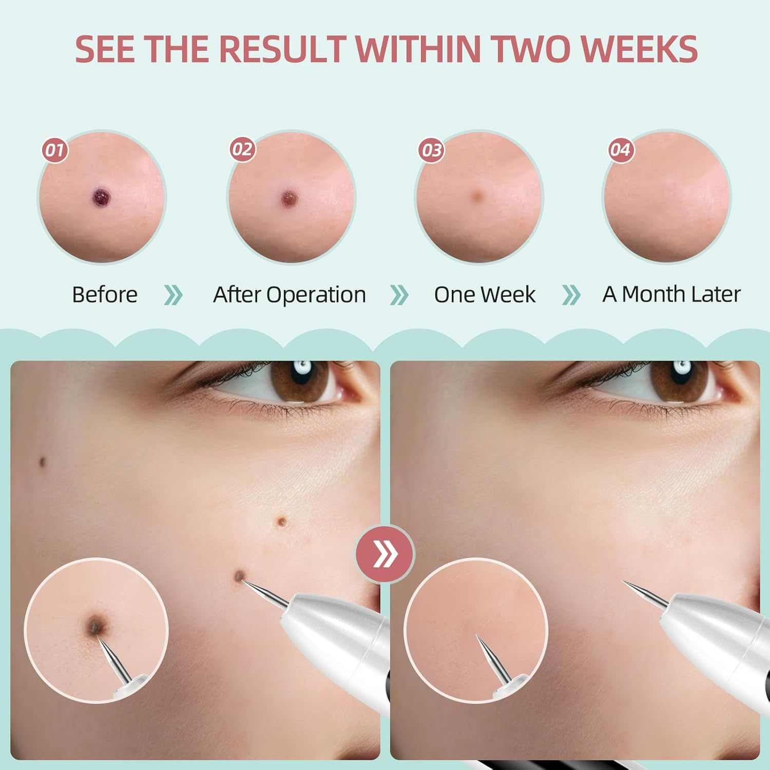 AL-40 Skin Removal Kit, Design to Smooth Your Skin, Safe and Effective for Home Use, Easy to Use Skin Tag Remover Kit image number 2