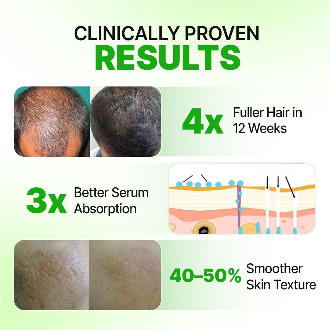 Sotrue Hair Growth Epifine Derma Roller 0.5 Mm with 540 Medical Grade Stainless Steel Needles, Activates Hair Follicles, Repairs Damaged Hair, for Face, Hair Fall & Hair Thickening, Reduces Acne Scars, Safe & Effective to Use image number 5