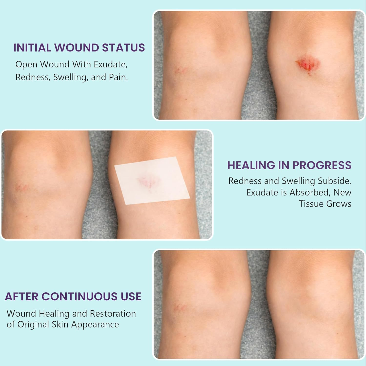 Medical-Grade Hydrocolloid Roll for Wound Care: 5Cm &times; 1.5M Hydrocolloid Bandages, Cut-To-Size Self-Adhesive Patch Dressing, Waterproof & Ultra Absorbent Tape for Burns, Blisters, Acne, First Aid Kit image number 3